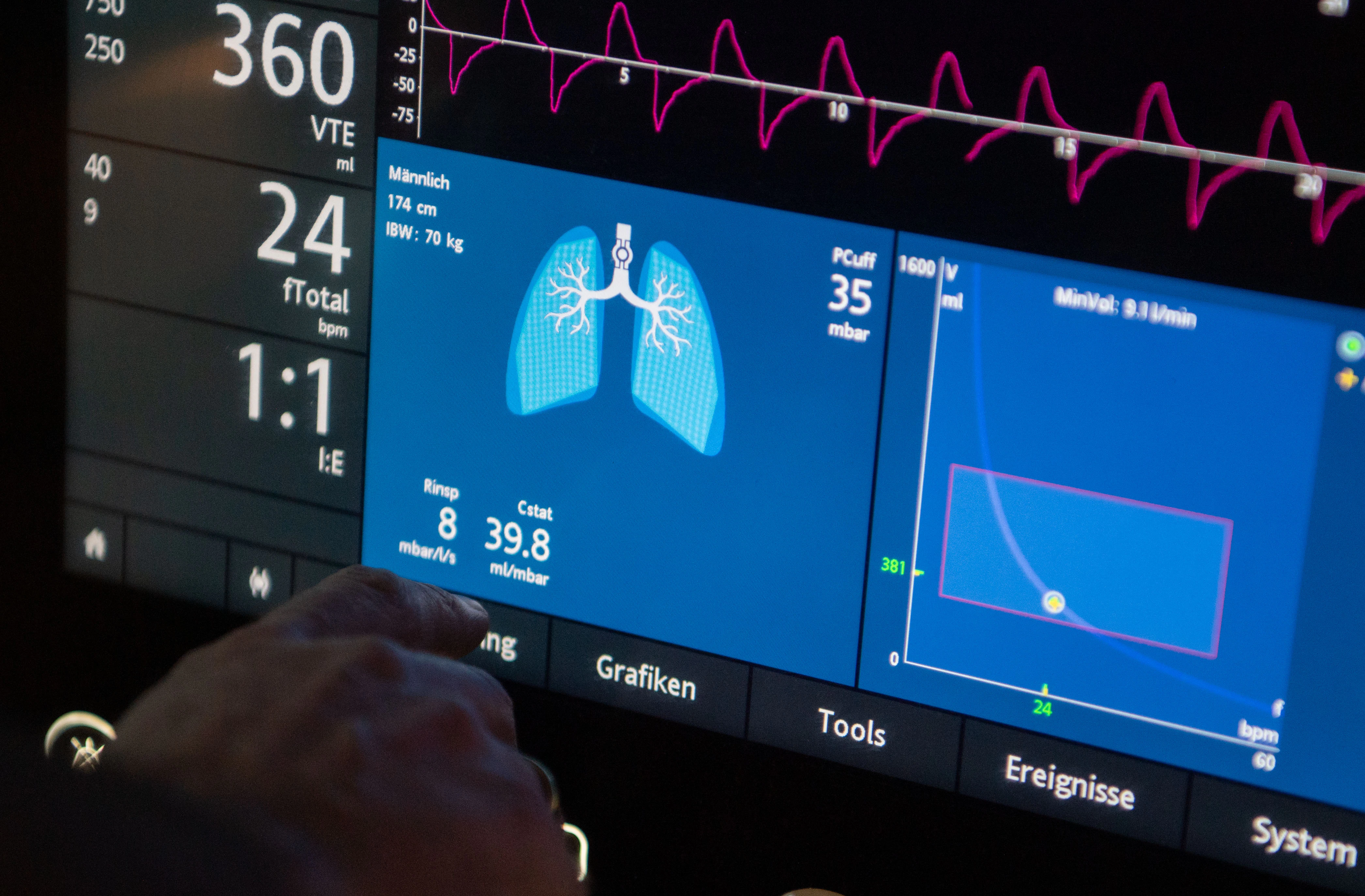 Was ARDS und ECMO bedeuten