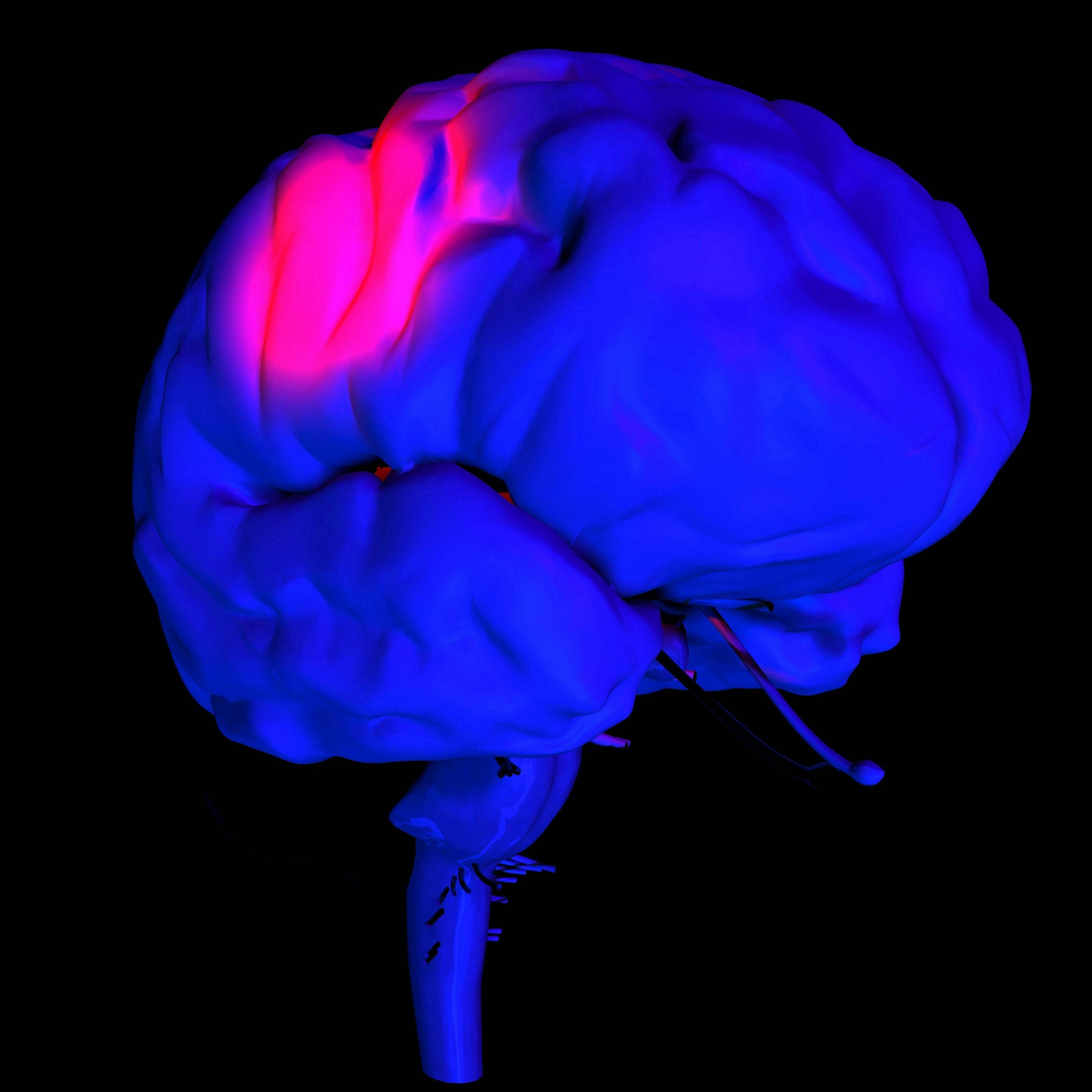 Ein Schlaganfall kann verschiedene Ursachen haben. Meist ist ein Gefäß verstopft, manchmal liegt eine Blutung vor. <br>