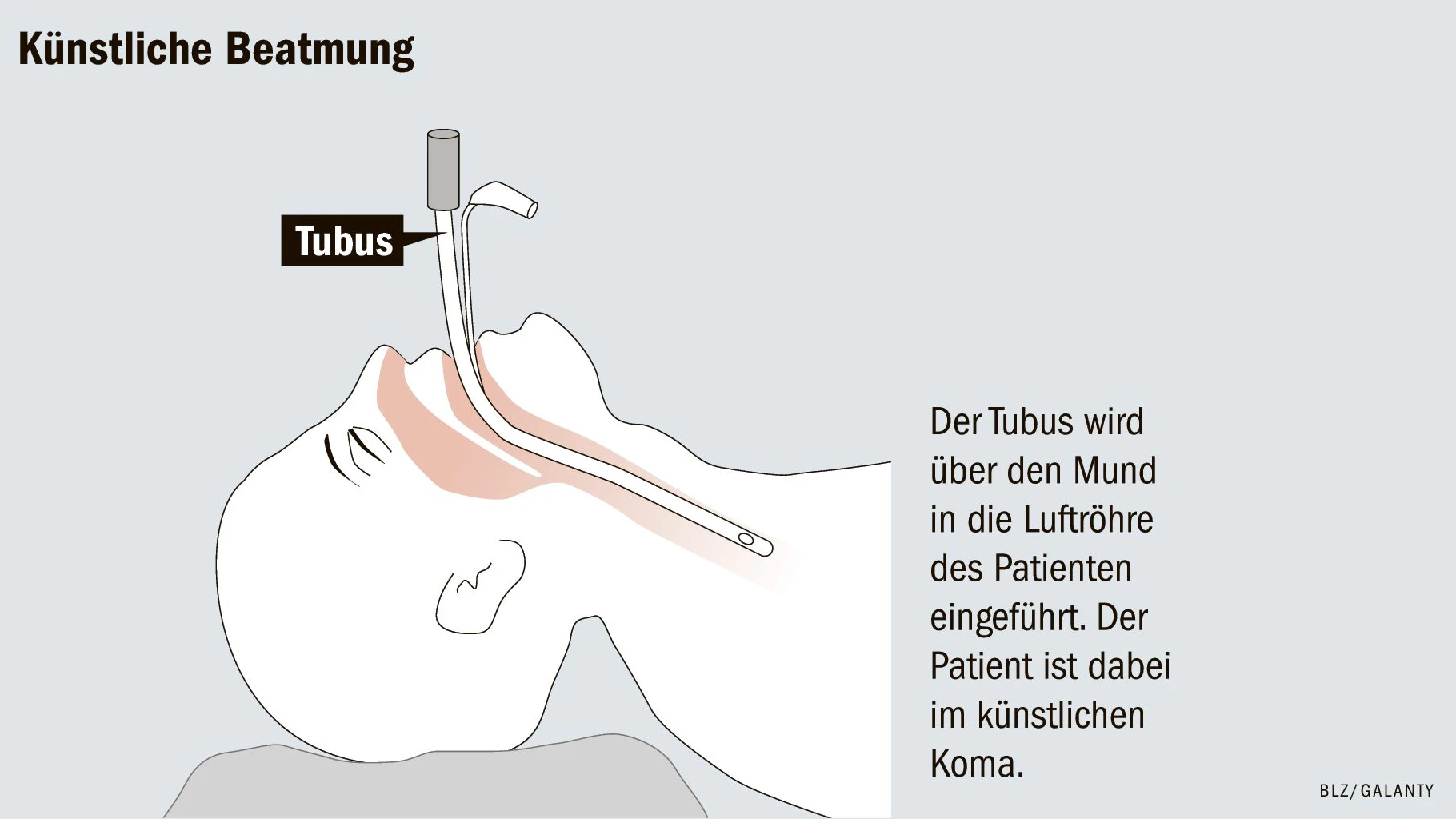 Covid-19: So funktioniert die Beatmungstherapie