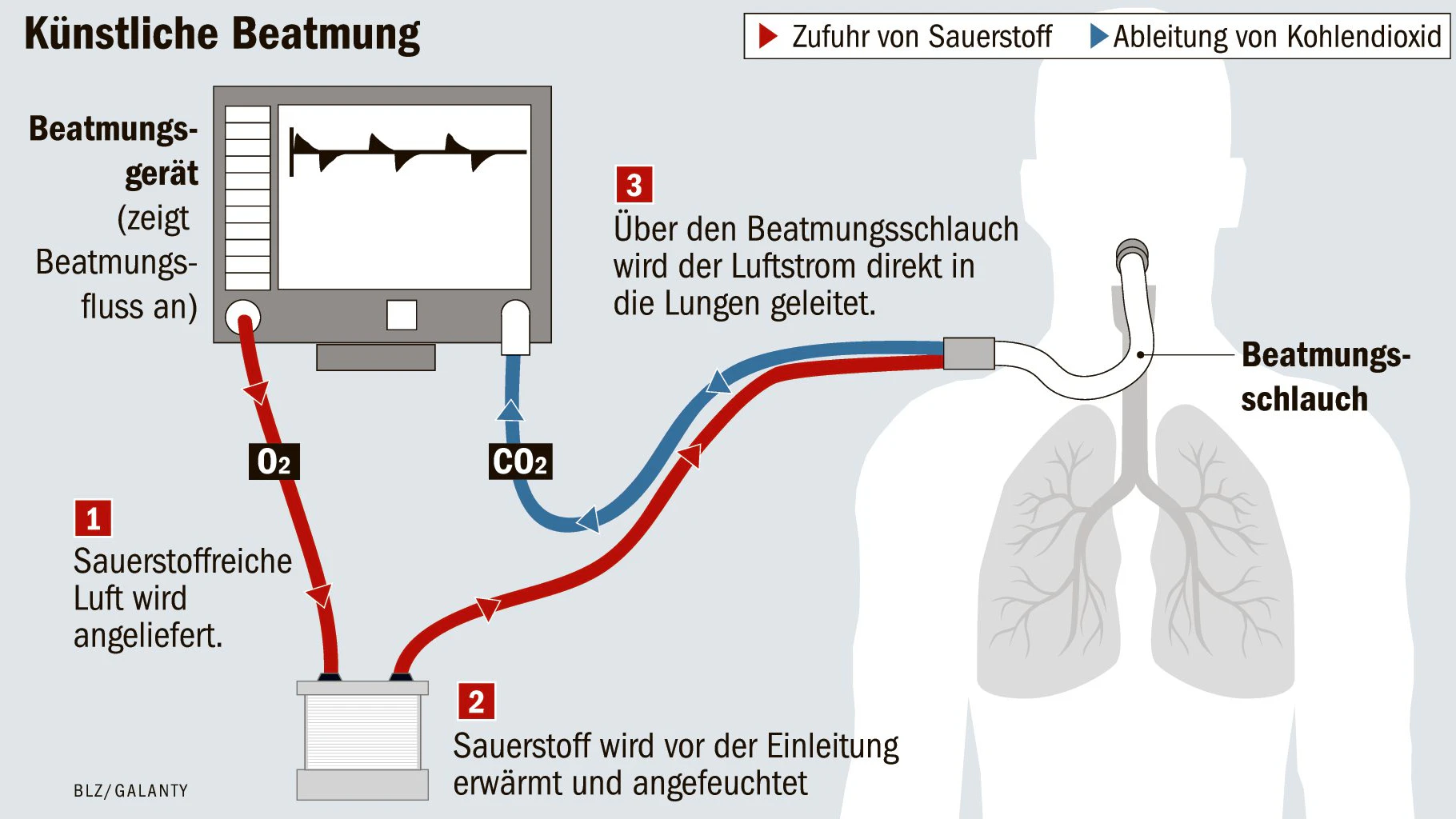 Covid-19: So funktioniert die Beatmungstherapie
