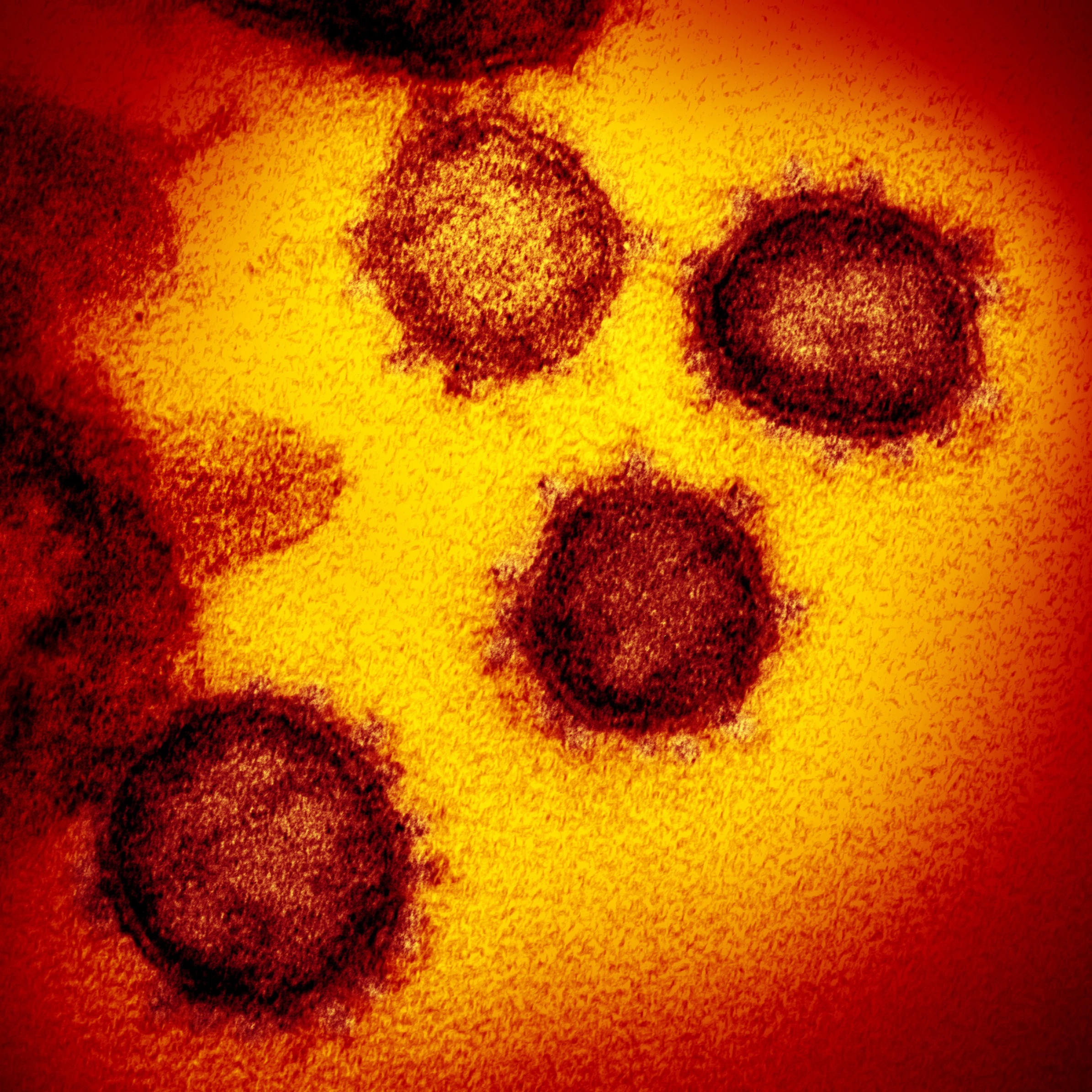 Sars-CoV-2- unter dem Elektronenmikroskop. Mit den Spike-Proteinen – den&nbsp; kleinen Stacheln, die ihm das charakteristische Aussehen geben – bindet sich das Virus an die Außenwände menschlicher oder tierischer Zellen und durchdringt sie.