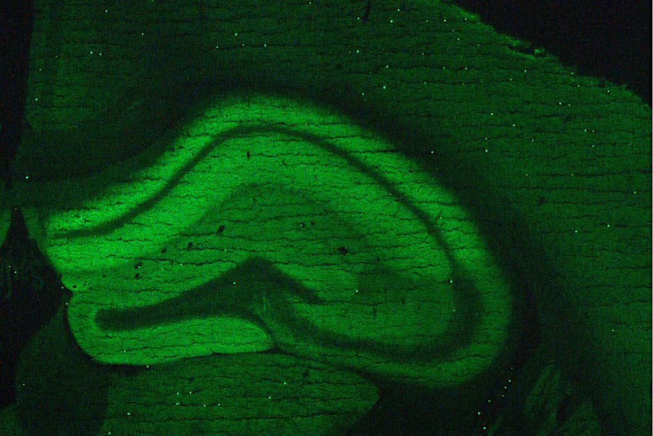 Gehirnentzündung als Folge von Autoimmunprozessen. Bei der NMDA-Rezeptor-Enzephalitis ist vor allem das Hirnareal Hippocampus betroffen. Die Entzündung wird durch körpereigene Antikörper verursacht, die sich an das Hirngewebe binden (hellgrün).