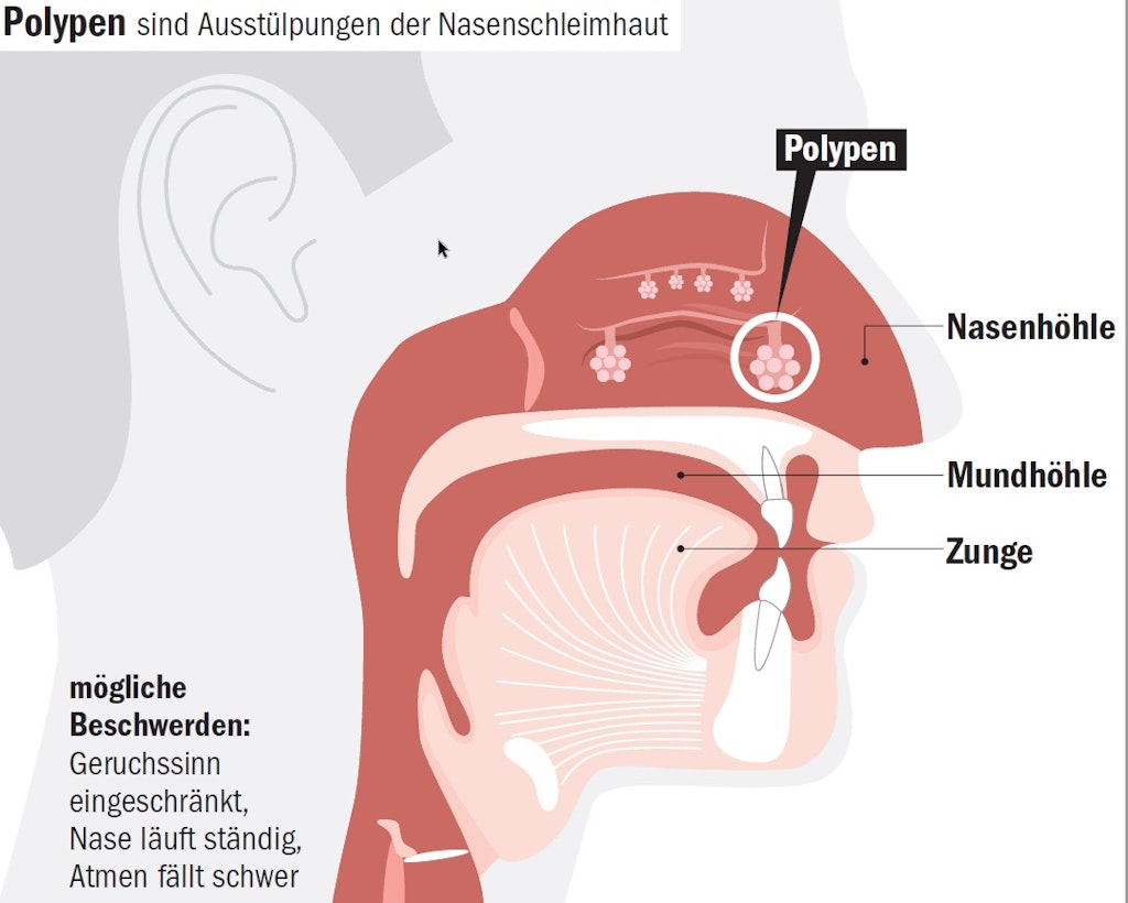 Teure Spritzen gegen Nasenpolypen