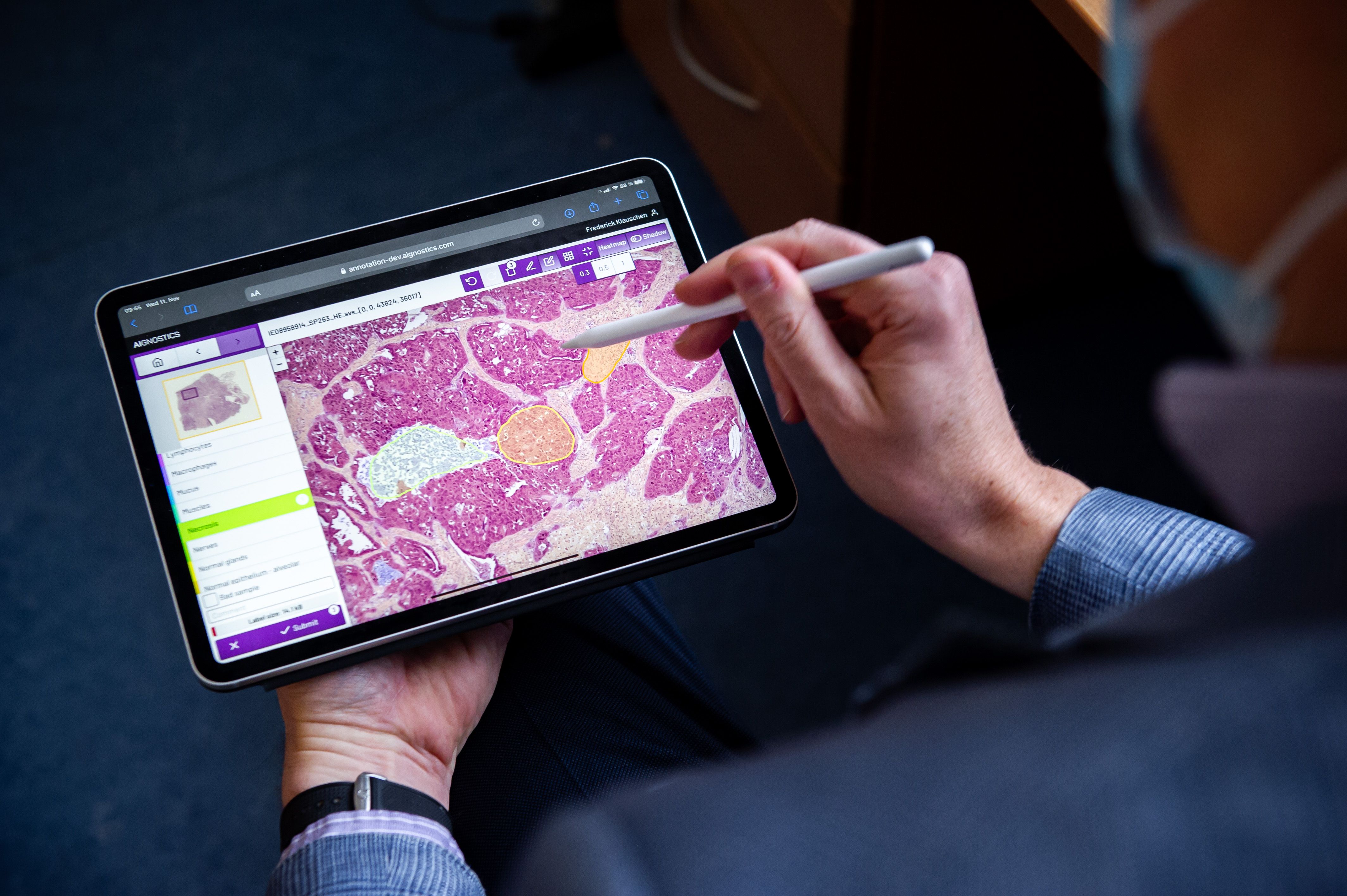 Wie Künstliche Intelligenz den Krebs besiegen soll