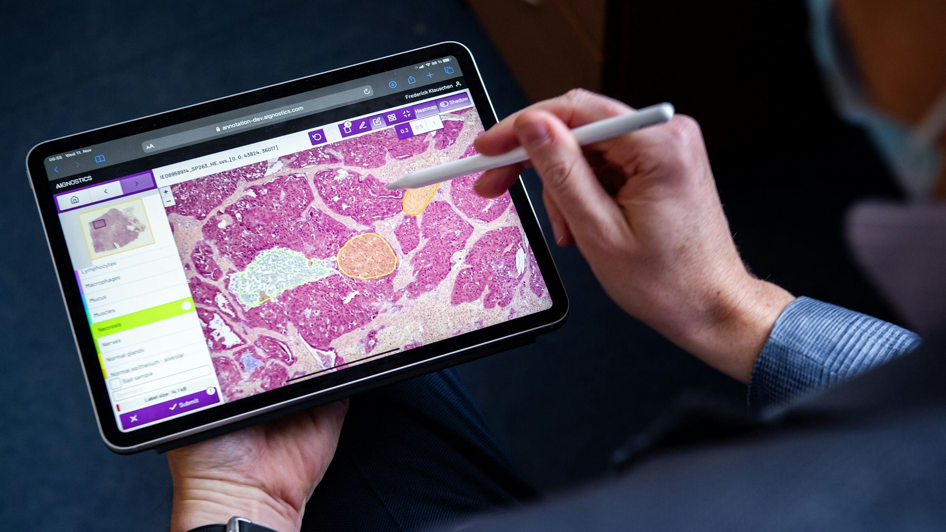 Der Pathologe Frederick Klauschen markiert erkranktes Gewebe. Die KI der Software Aignostics wird so trainiert.