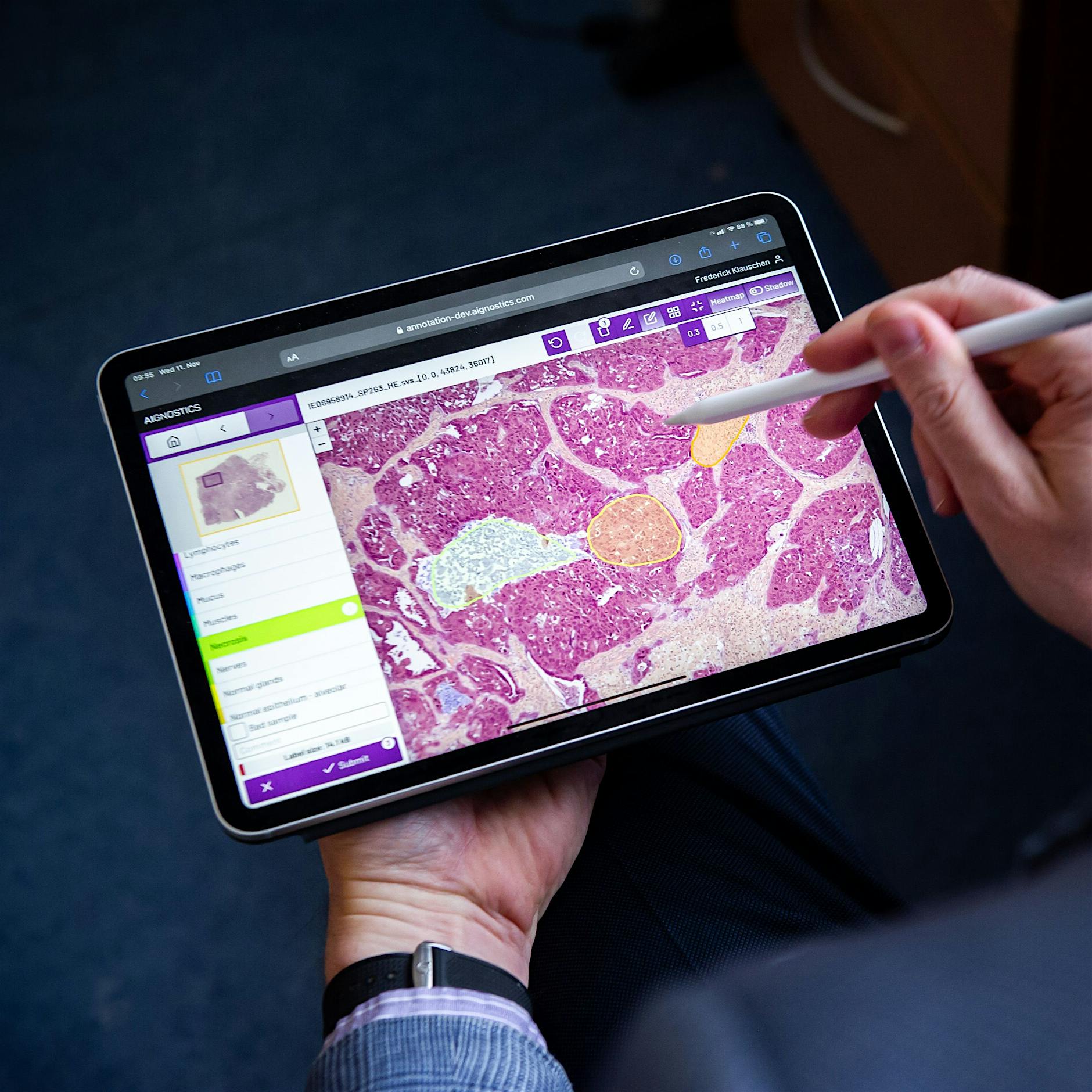 Wie Künstliche Intelligenz den Krebs besiegen soll