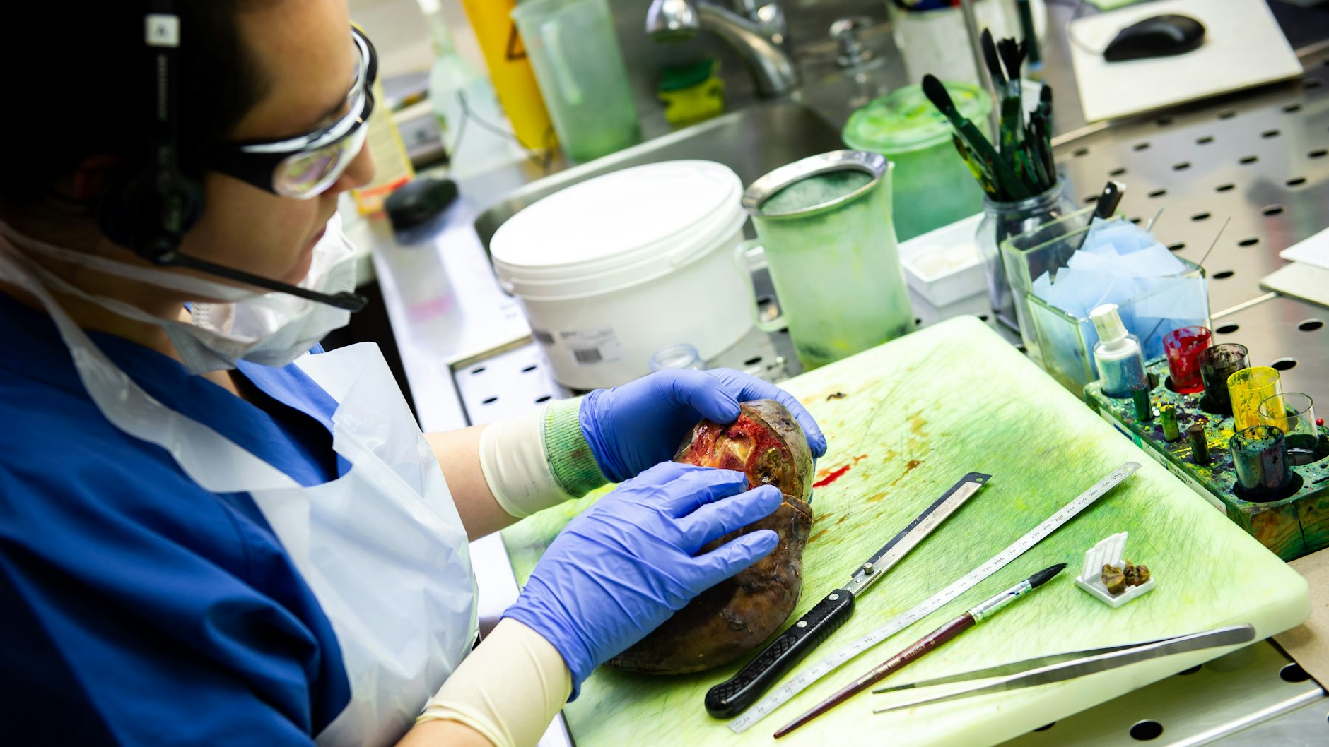 Eine Assistenzärztin in dem pathologischen Labor der Charité schneidet eine Leber auf und entnimmt eine Gewebeprobe der Metastase.