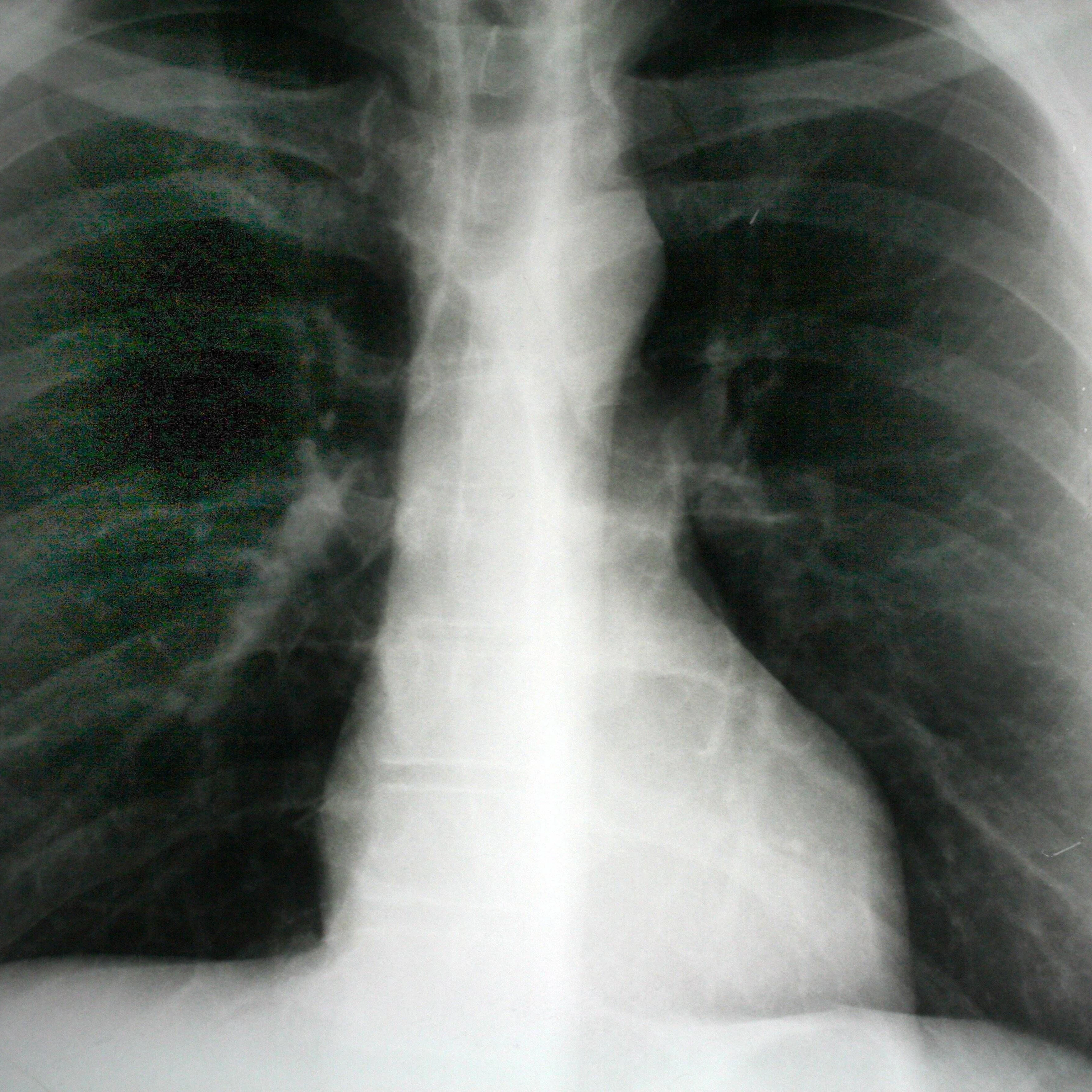 Eine Röntgenaufnahme des&nbsp;Brustkorbs (Thorax).