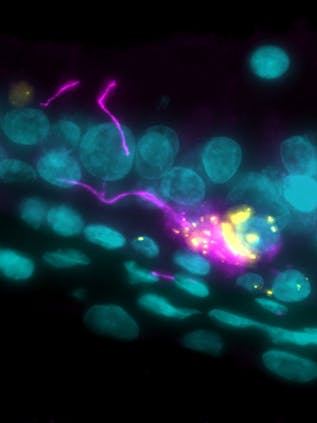 Durch sogenannte Immunfluoreszenz-Färbung sichtbar gemacht: eine mit <a href="https://www.charite.de/service/glossar/begriff/sars_cov_2/">Sars-CoV-2</a> (gelb) infizierte Nervenzelle (pink) in der Riechschleimhaut. 