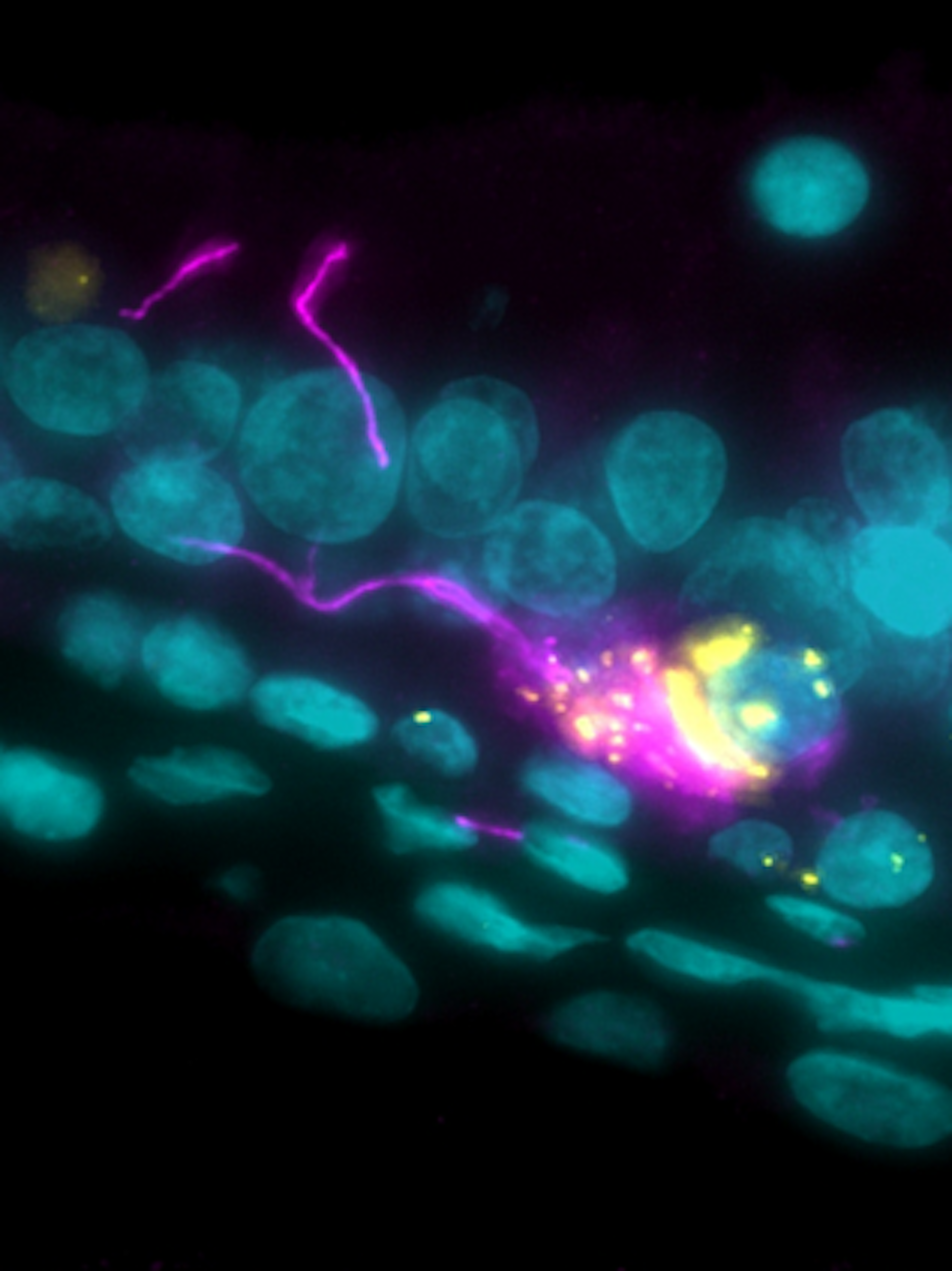 Durch sogenannte Immunfluoreszenz-Färbung sichtbar gemacht: eine mit <a href="https://www.charite.de/service/glossar/begriff/sars_cov_2/">Sars-CoV-2</a> (gelb) infizierte Nervenzelle (pink) in der Riechschleimhaut.&nbsp;&nbsp;