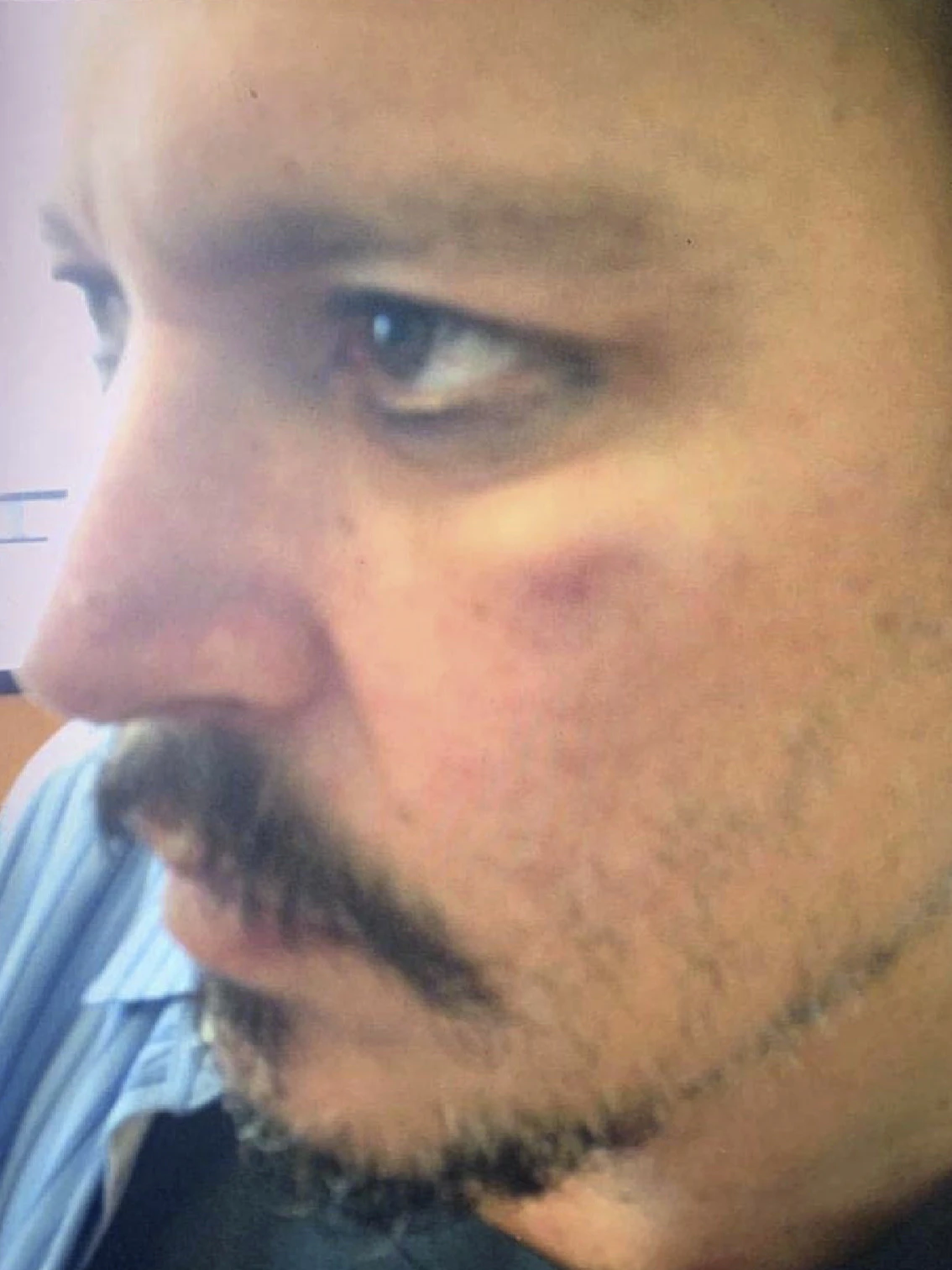 Beweismittel vor Gericht: Das Gesicht Johnny Depps weist Verletzungen auf, die er durch seine Ex-Frau Amber Heard erlitten haben soll.