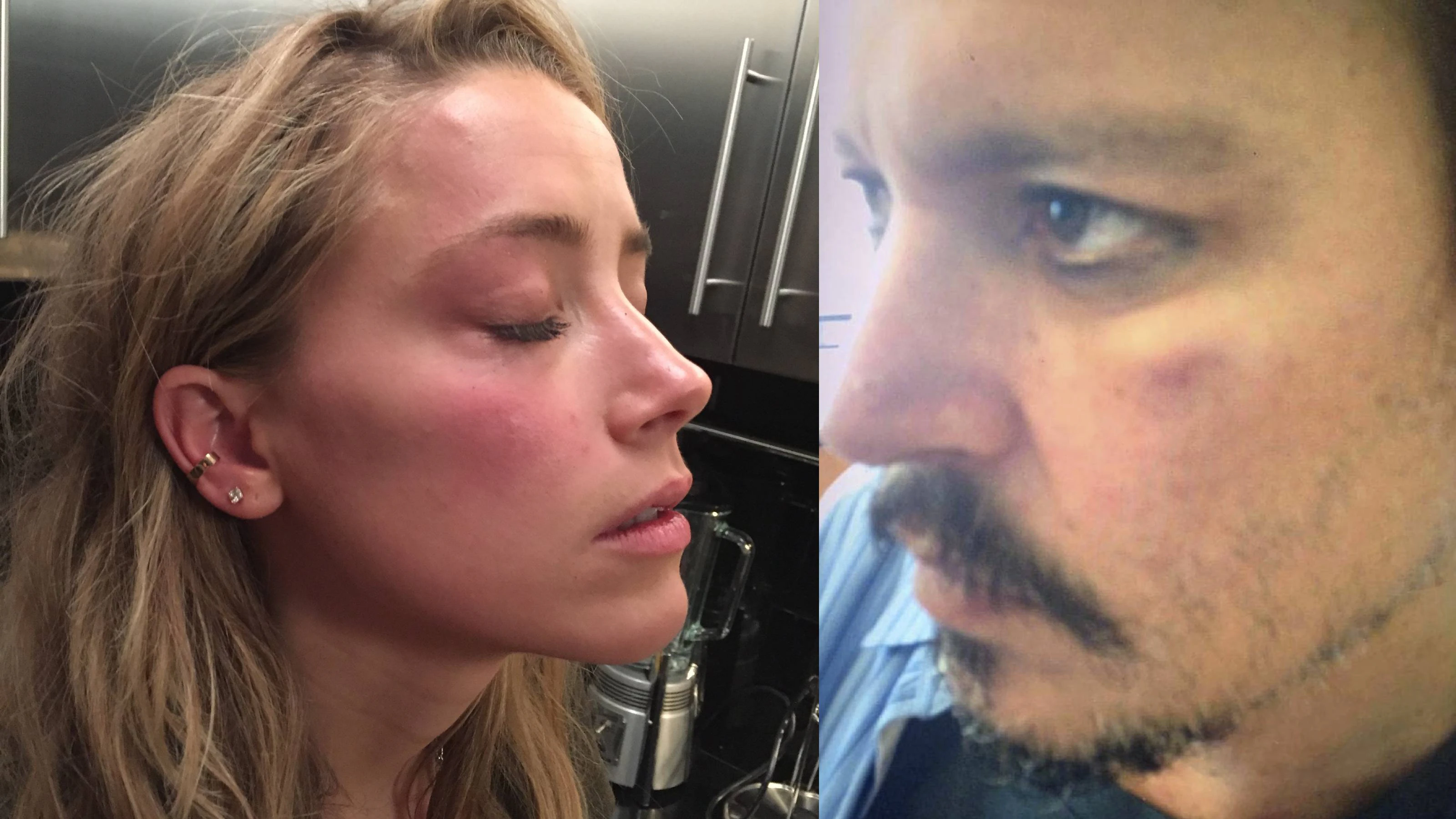 Amber Heard und Johnny Depp gaben beide an, Verletzungen aus der Beziehung davongetragen zu haben