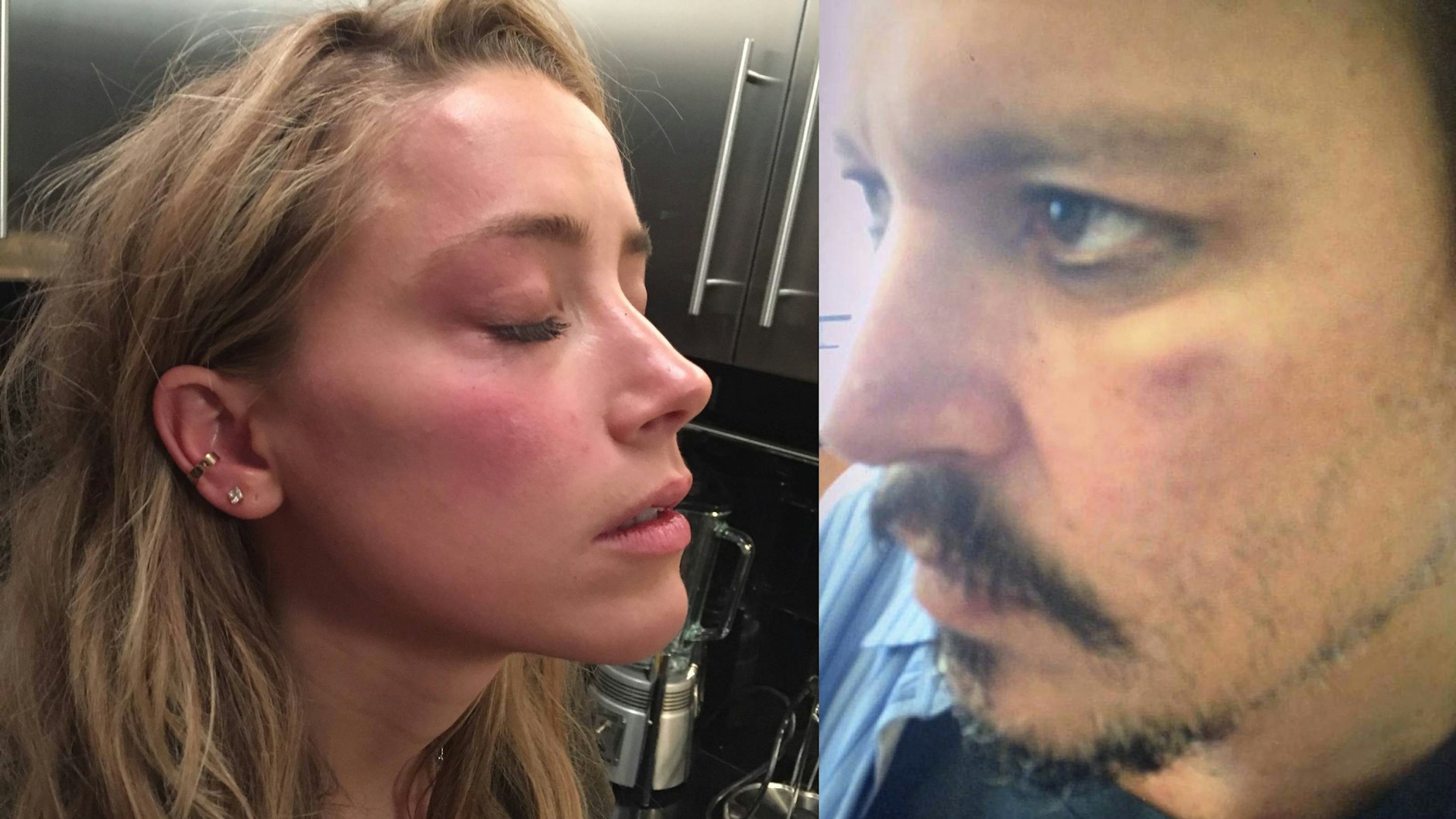 Amber Heard und Johnny Depp gaben beide an, Verletzungen aus der Beziehung davongetragen zu haben