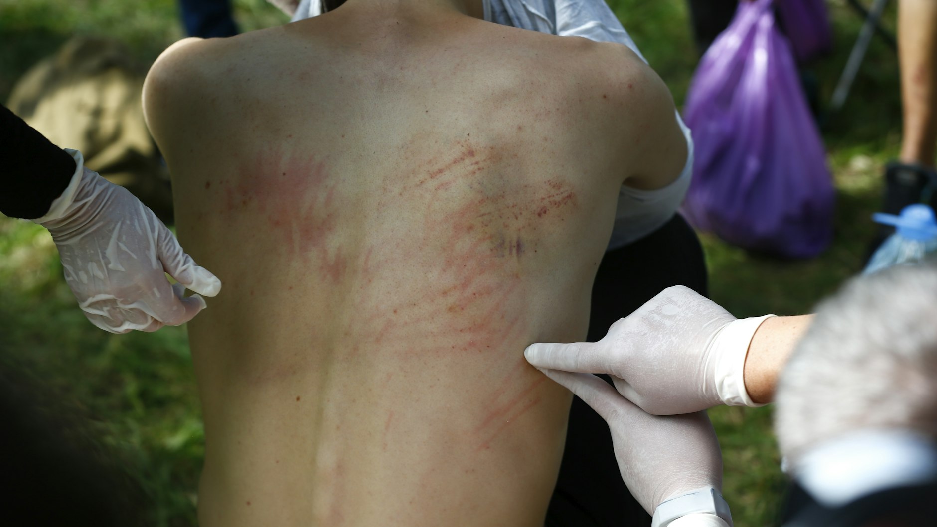 Ein Mann zeigt die Wunden auf seinem Rücken. Polizisten hätten ihn in der Haft brutal geschlagen, klagt er an. 