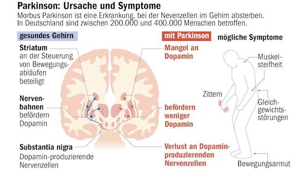 „Wir sind überzeugt, dass Parkinson heilbar ist“