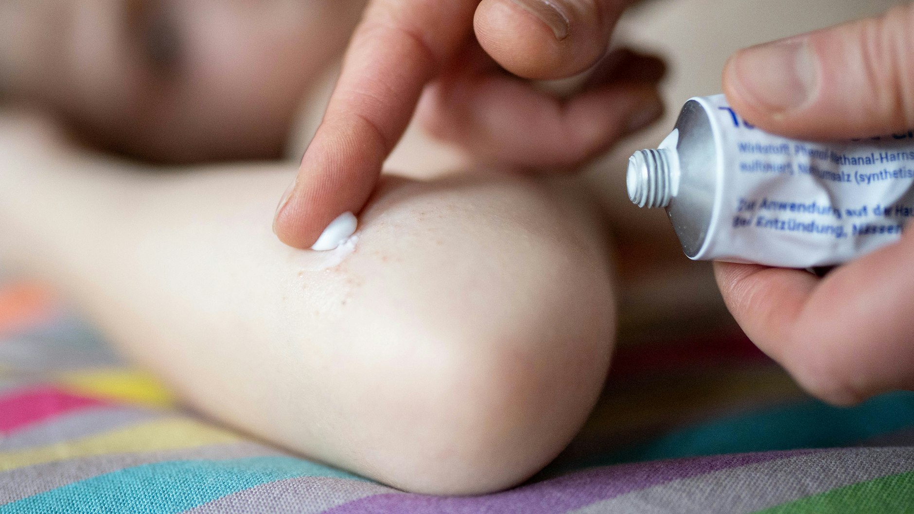 Cremen, cremen, cremen: Bei&nbsp; Neurodermitis ist auch Feuchtigkeitspflege wichtig.