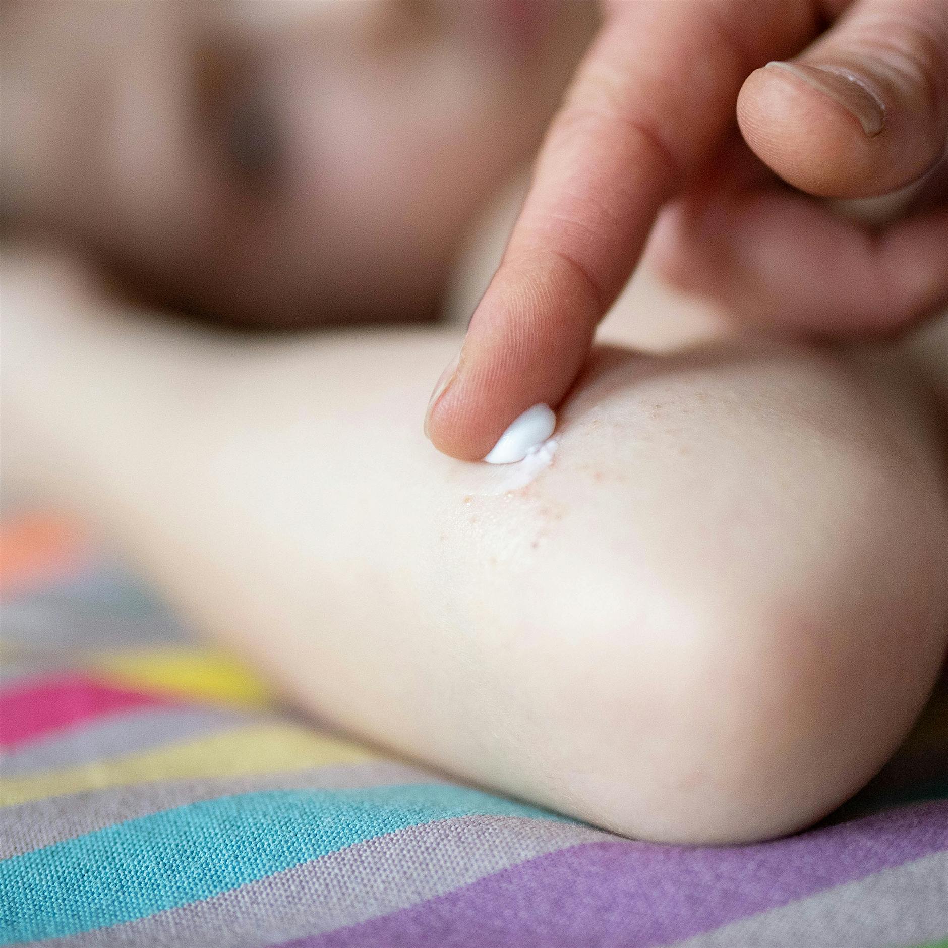 Probiotisches Spray könnte Neurodermitis lindern