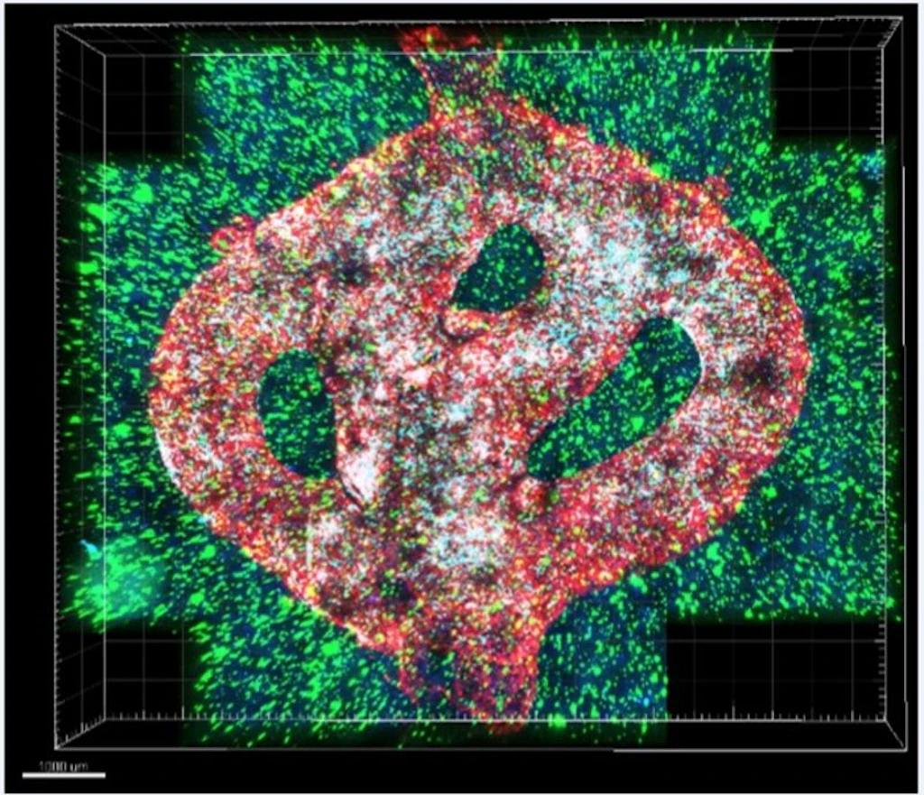 Krebs: Forscher stellen Hirntumor samt Gefäßsystem im 3D-Drucker her