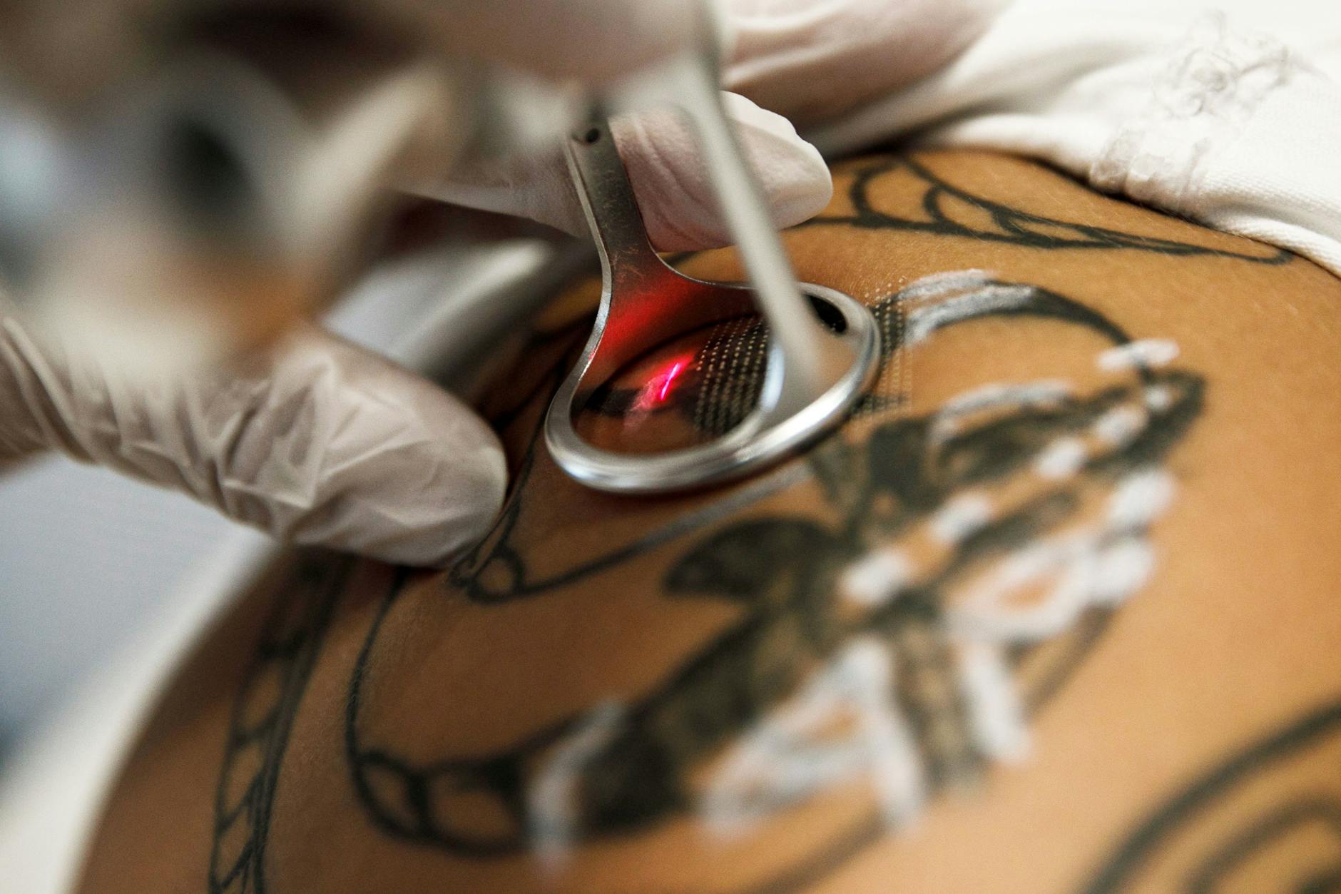 Wenn ein Tattoo per Laser entfernt wird, muss die Behandlung in der Regel mehrmals wiederholt werden. Zwischen den Sitzungen sollten vier bis sechs Wochen liegen.