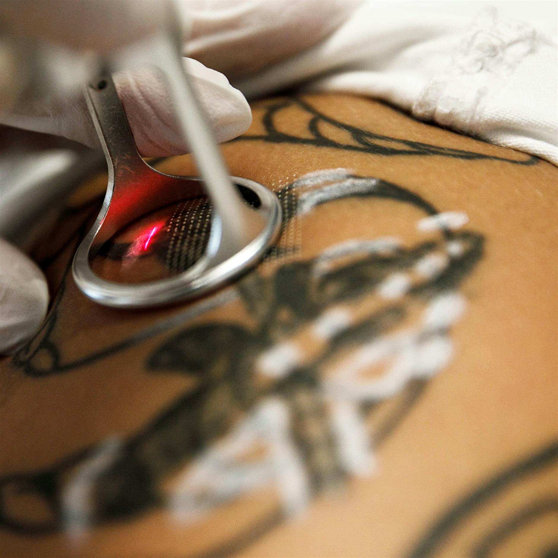 Laser, Cover-up oder Skalpell: Wie lassen sich Tattoos entfernen?