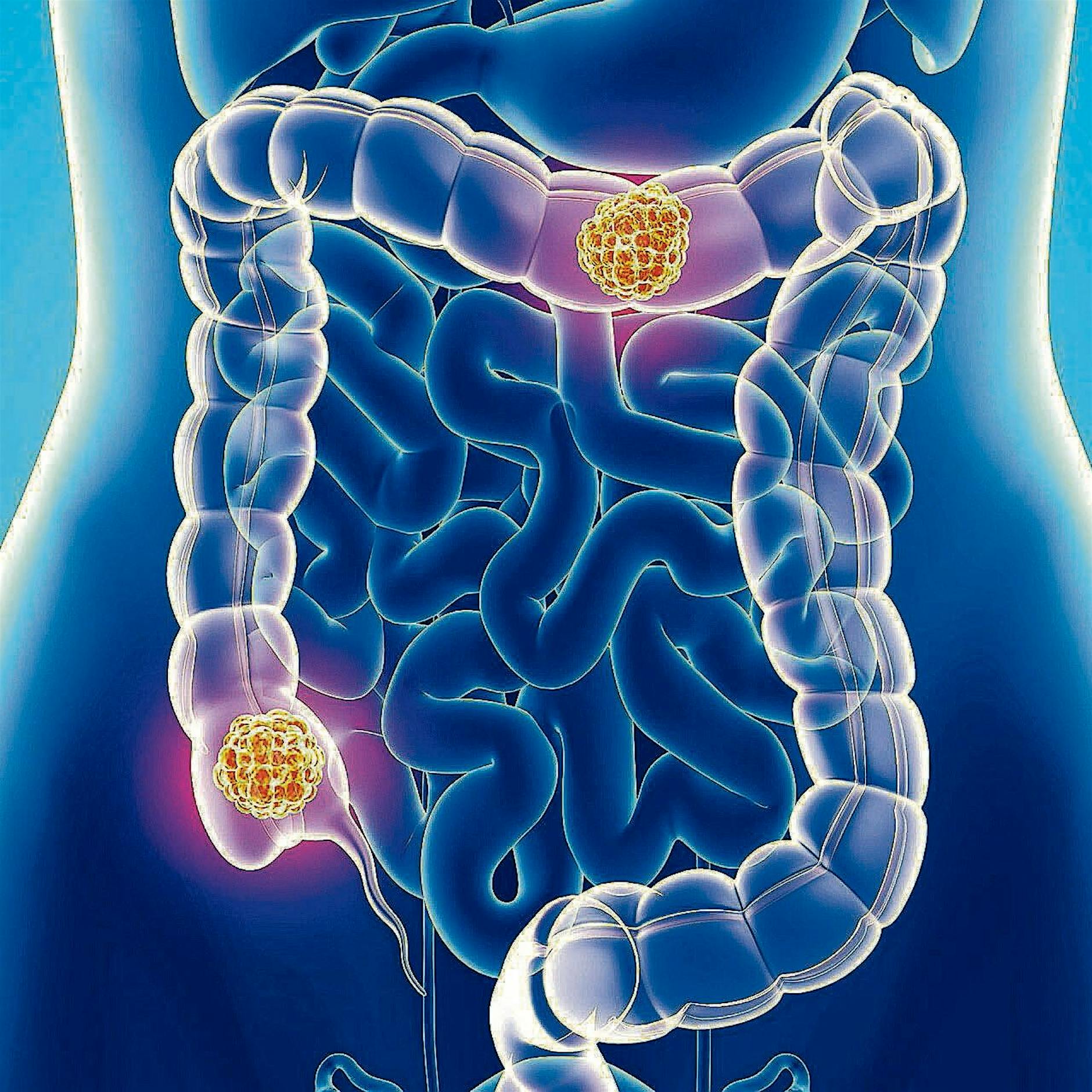 Häufige Antibiotika-Einnahme erhöht Darmkrebs-Risiko