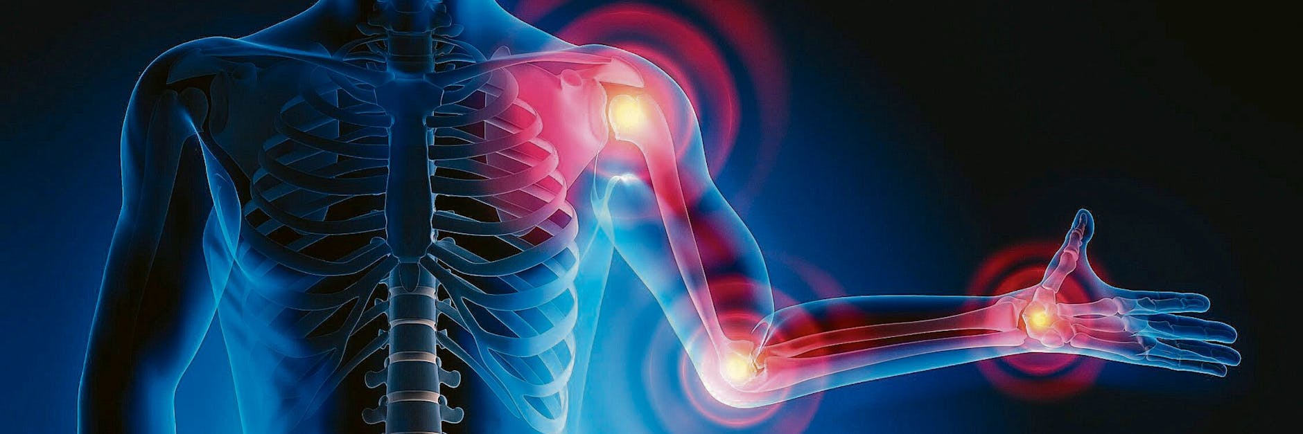 Gicht entsteht oftmals da, wo zuvor eine Arthrose die Gelenke bereits geschädigt hat.