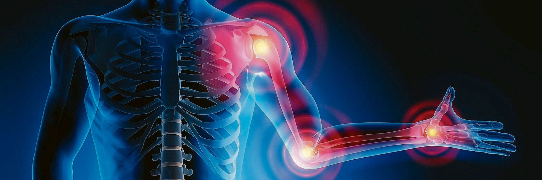 Gicht entsteht oftmals da, wo zuvor eine Arthrose die Gelenke bereits geschädigt hat.