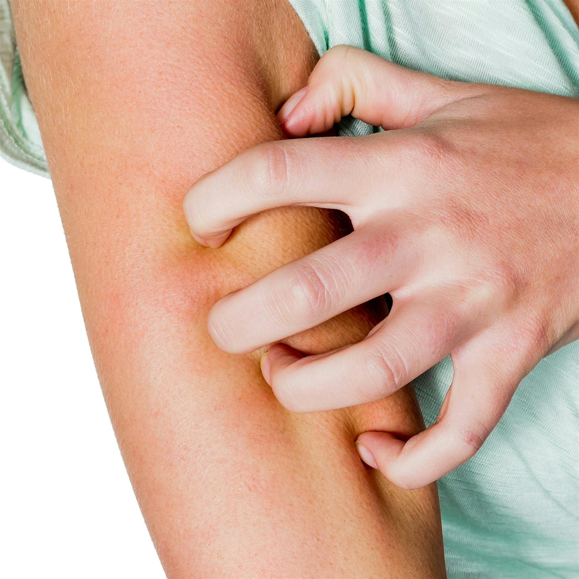 Dermatologe: So bekommen Sie Ihre Schuppenflechte in den Griff