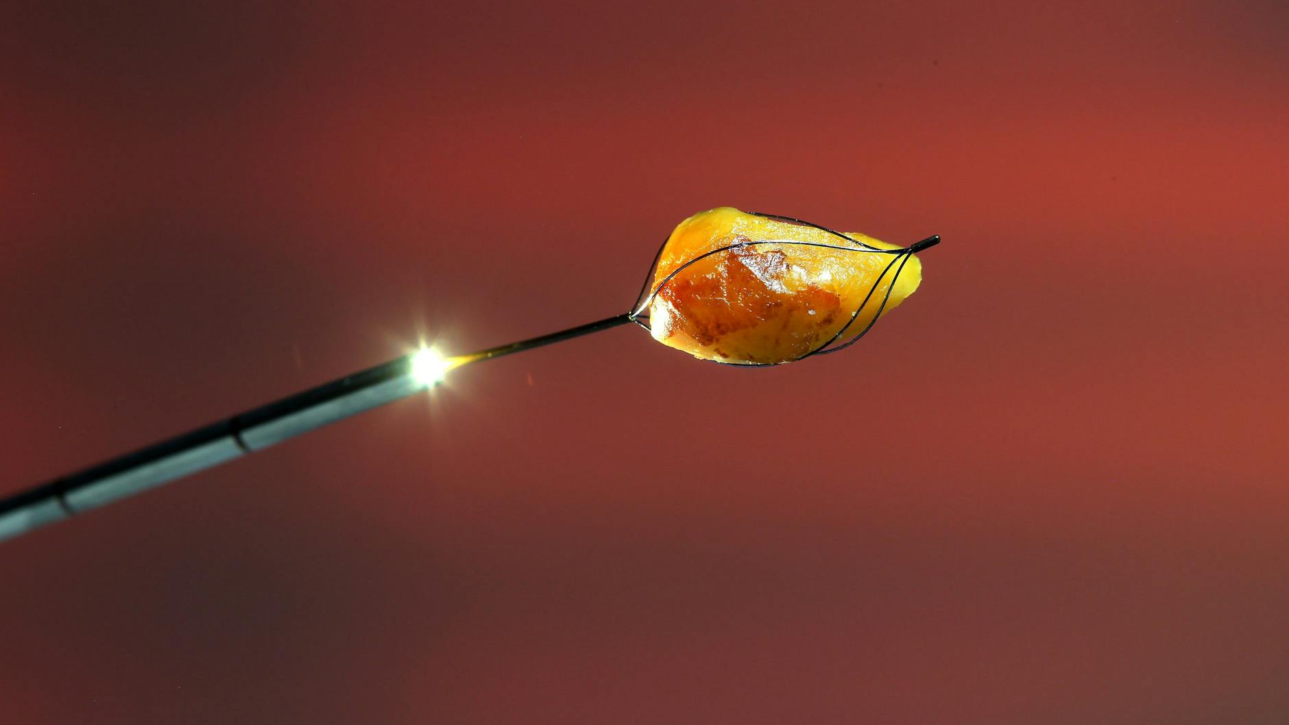 So sah der Speichelstein aus, der aus Angelinas Mund entfernt wurde.