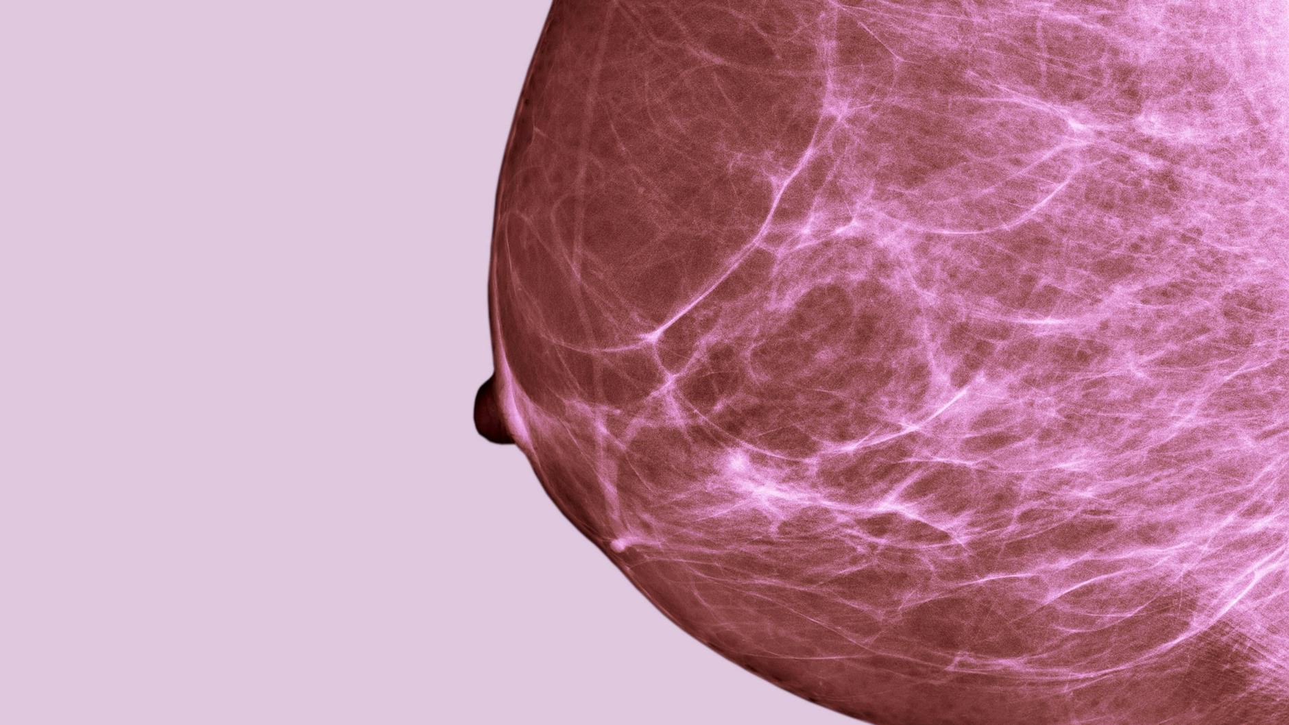 Röntgenaufnahme einer Brust. In Deutschland stehen Mammographie-Screenings Frauen im Alter zwischen 50 und 69 alle zwei Jahre zu. 