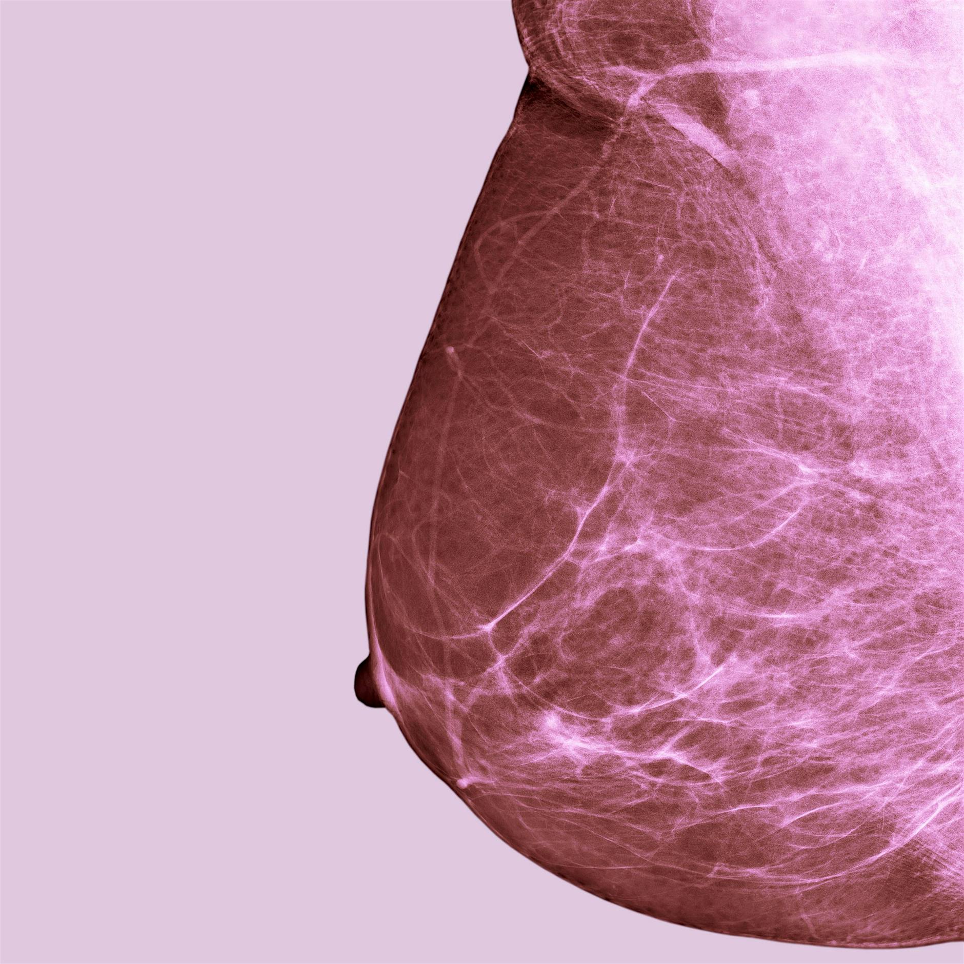 Wo Brustkrebs am häufigsten auftritt