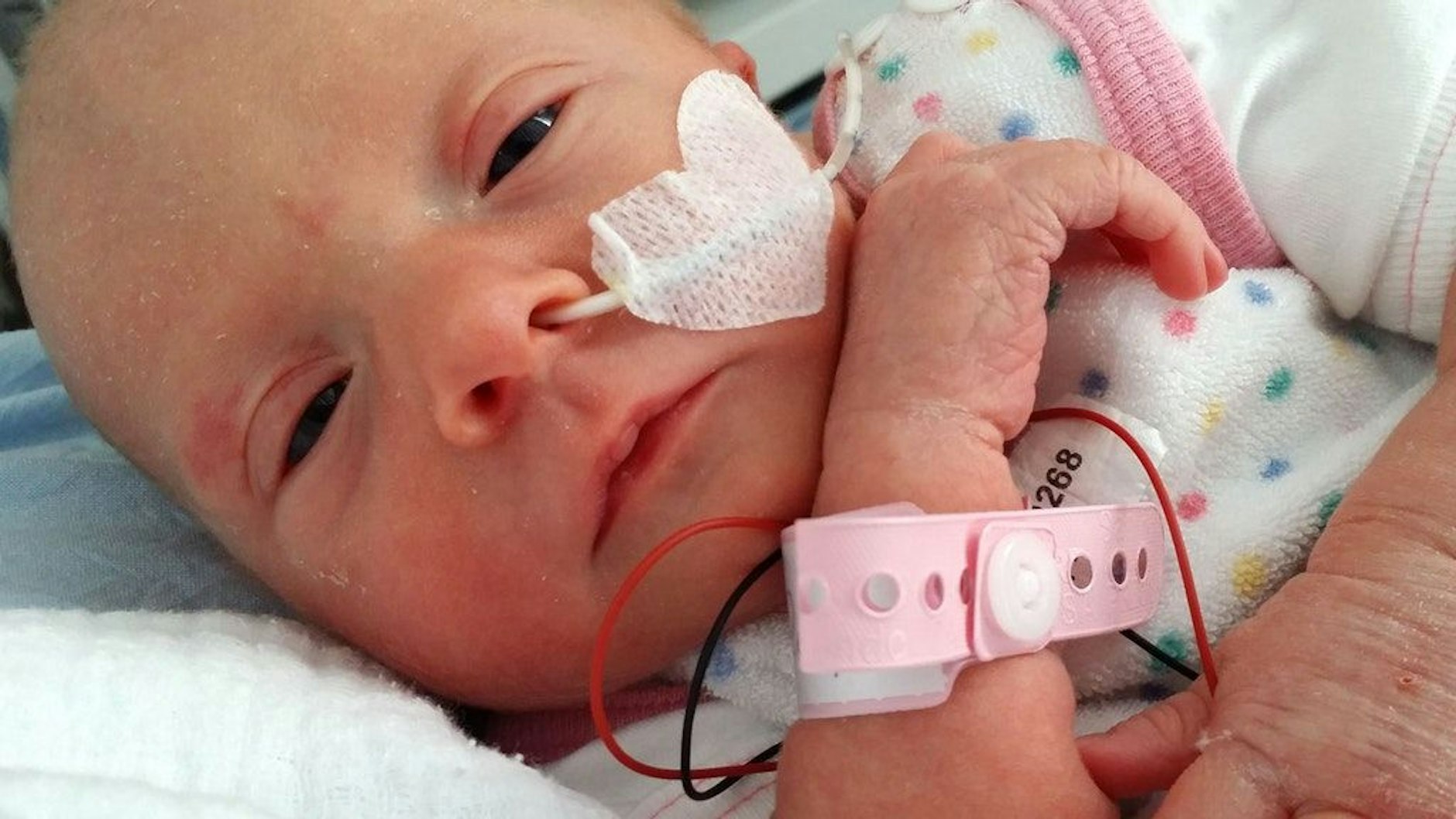 Die Nahrung bekommt Frühchen Ruby an den ersten Tagen über eine Magensonde, weil sie zum Trinken nach ihrem Frühstart ins Leben noch zu schwach ist.