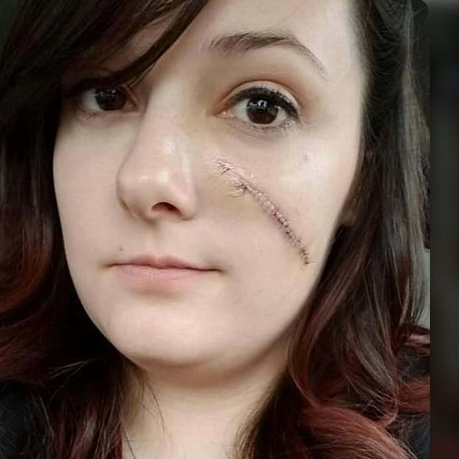 Kayla brauchte noch mehrere Schönheitsoperationen, um das Loch zu schließen.