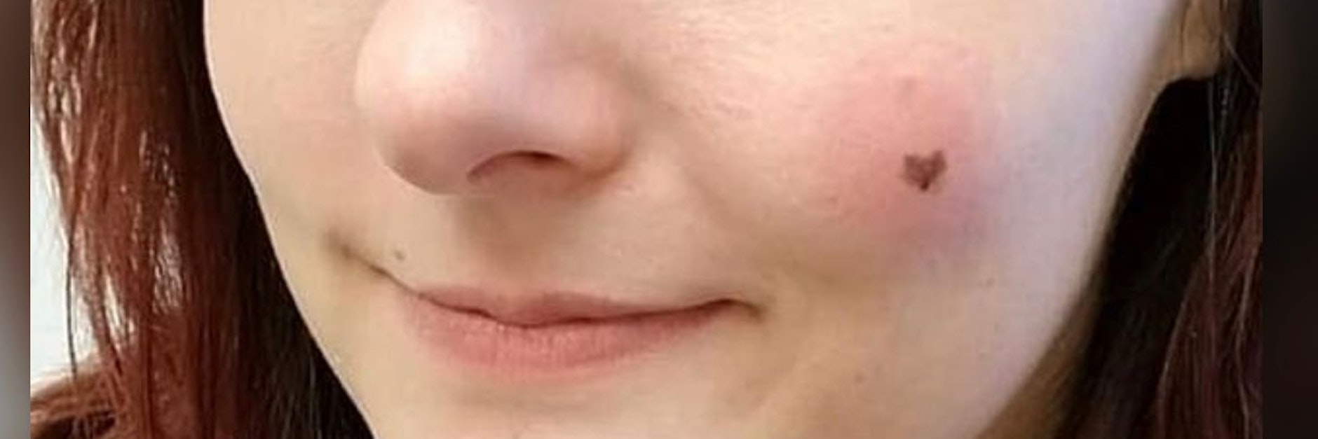 Sie war jahrelang stolz auf ihr „Schönheitsmakel“ auf ihrer Wange. Denn Kayla Mailers kleines Muttermal hatte die Form eines perfekten Herzens.