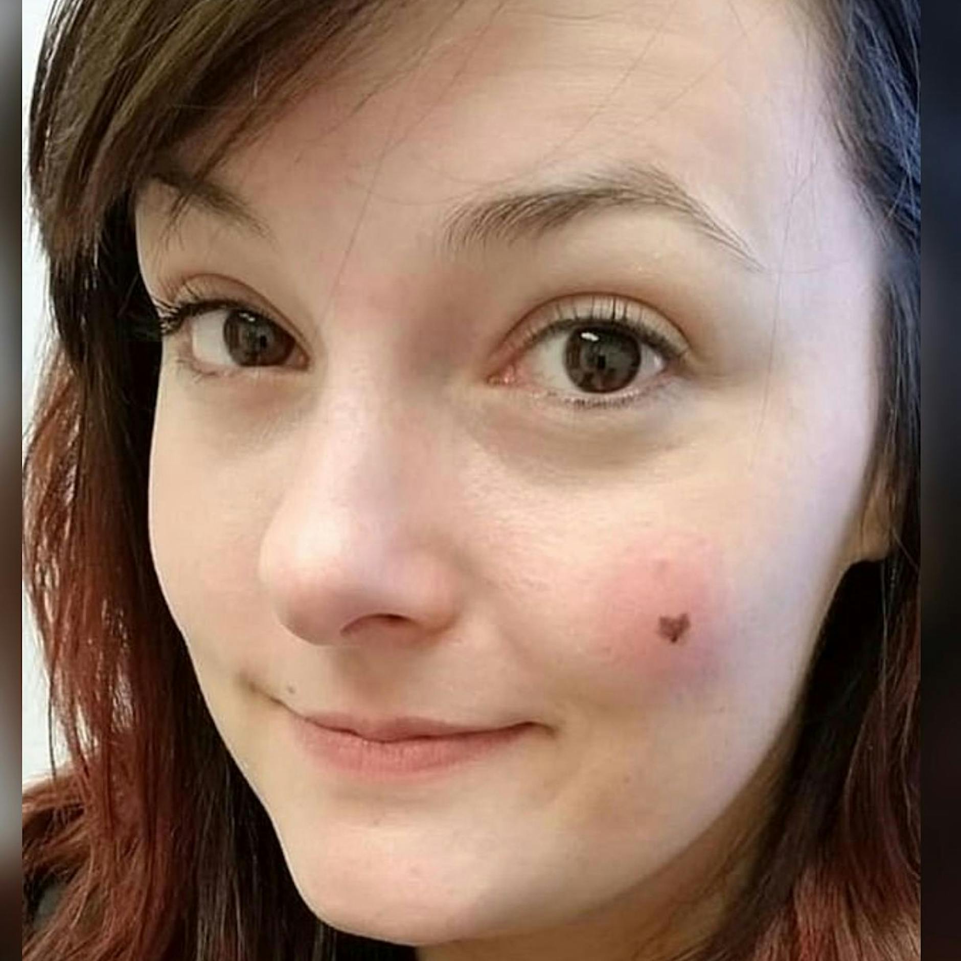 „Perfektes Herz“ war tödlicher Hautkrebs: Ihr kleines Muttermal hätte Kayla fast umgebracht