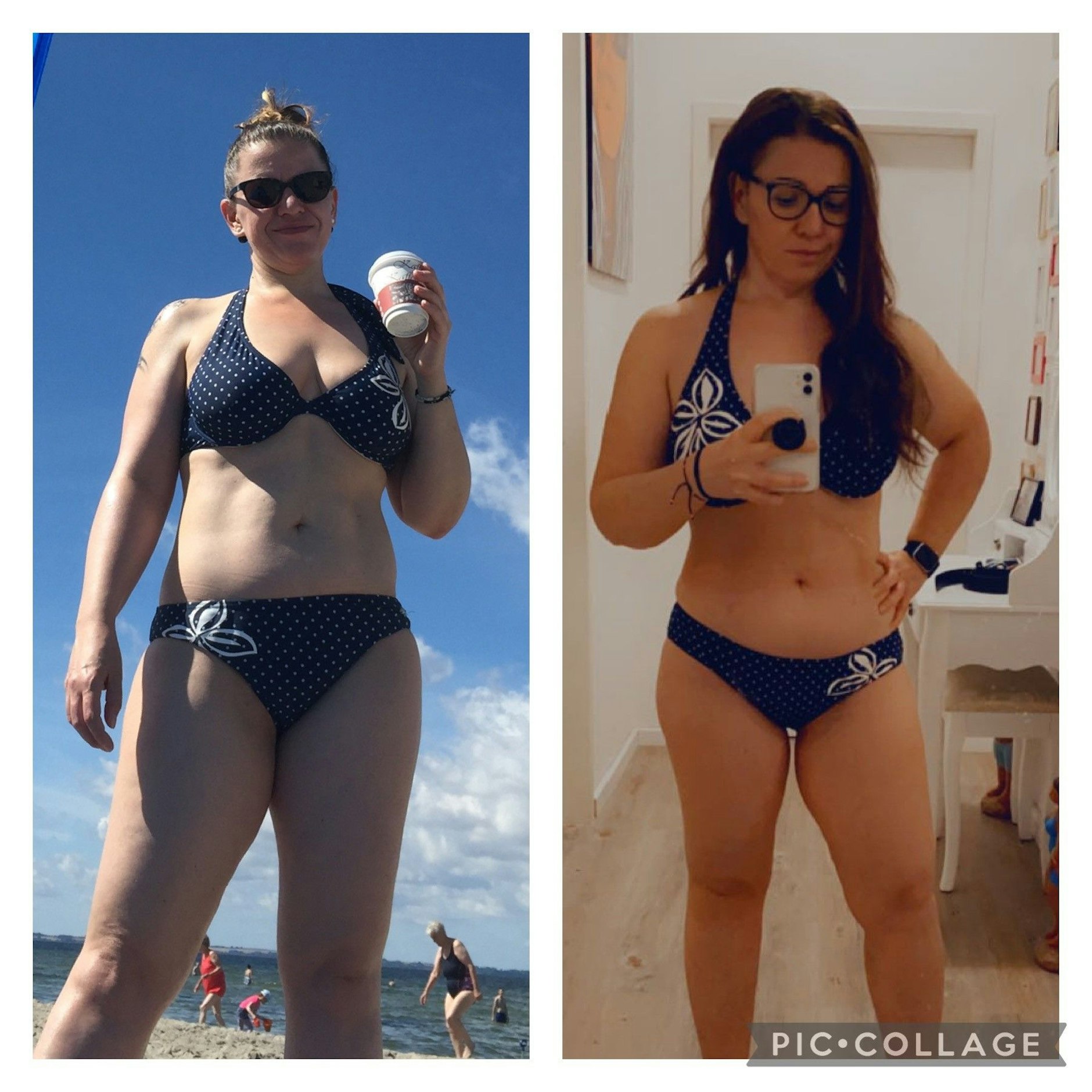 Bei Jana Ferrari bildet sich an bestimmte Körperstellen krankhaft Unterhautfettgewebe.