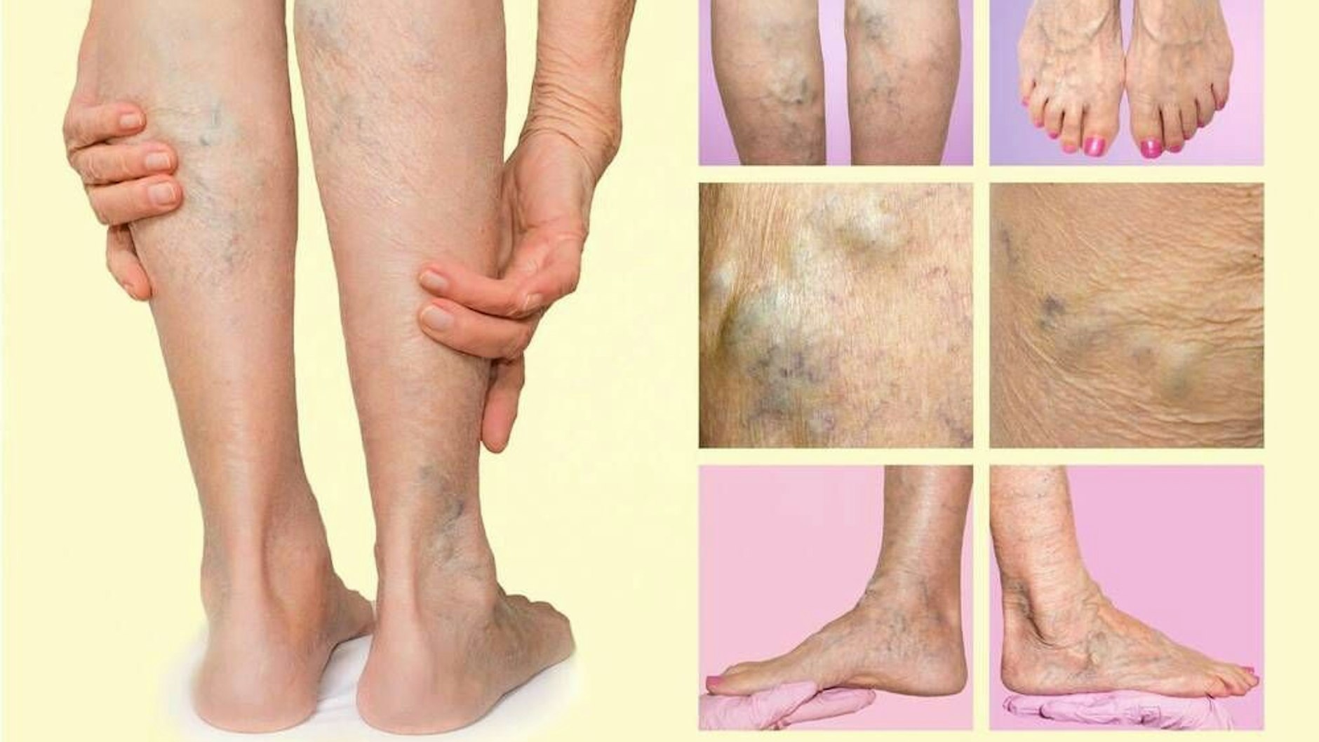 Wer Ödeme zum Beispiel an den Beinen feststellt, sollte seinen Körper entwässern.