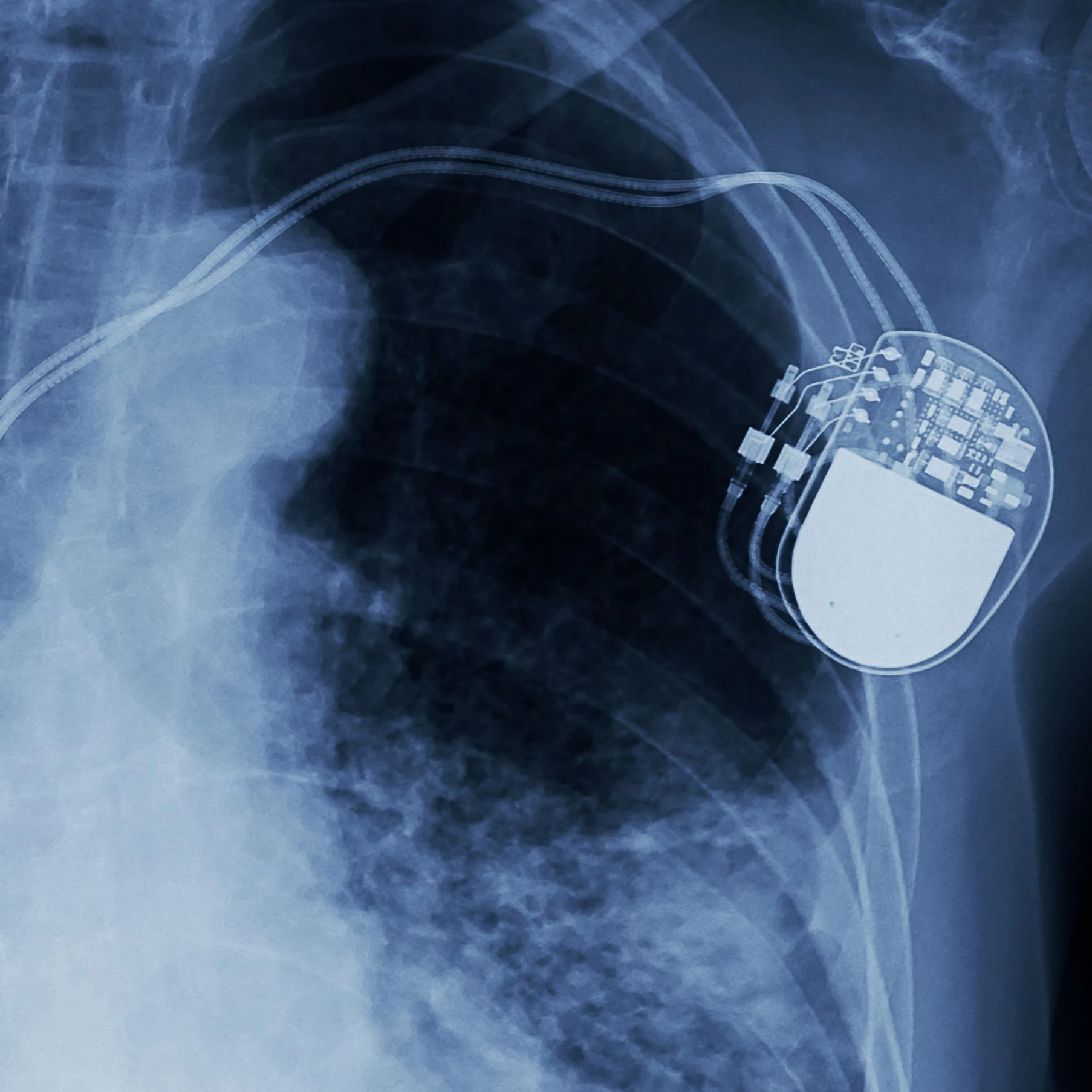 Geht unter die Haut: ein implantierter Defibrillator.
