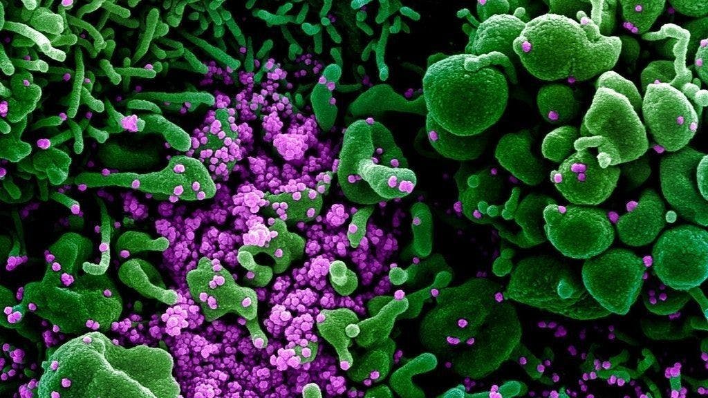Eine Zelle (grün) ist mit dem Coronavirus (violett) infiziert.