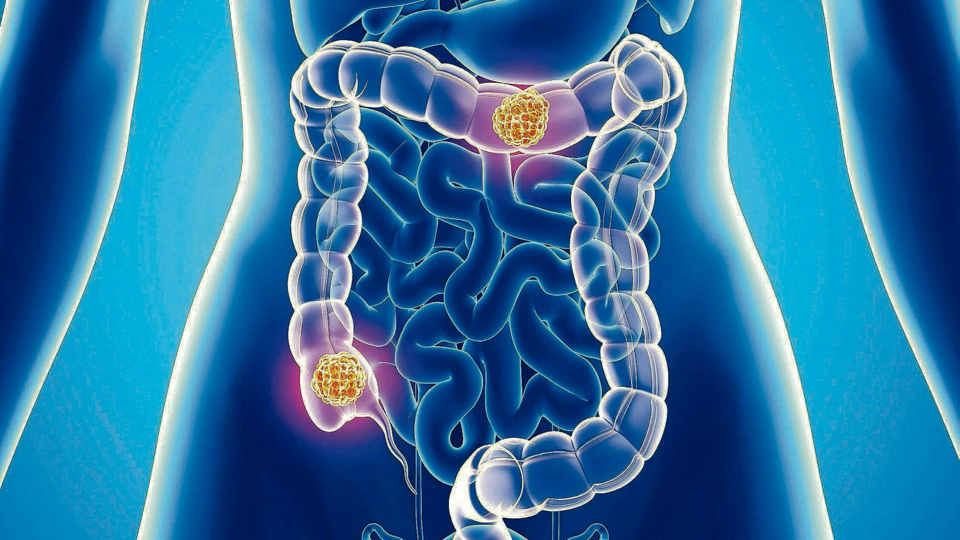 Darmkrebs (Illustration) kann man nicht sehen und auch lange nicht spüren. Das macht ihn so gefährlich.