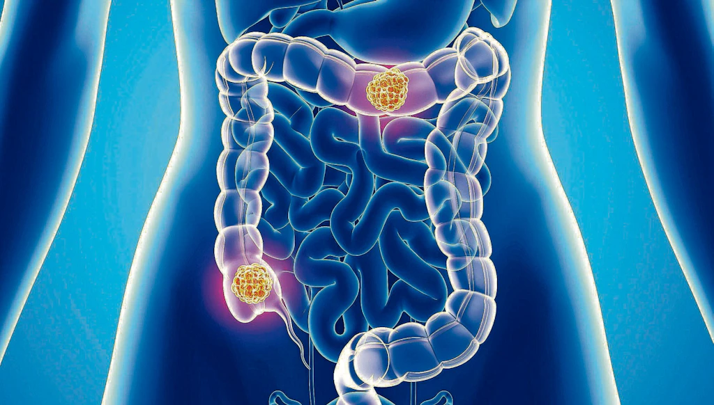 Blut im Stuhl: Hämorrhoiden oder Darmkrebs?