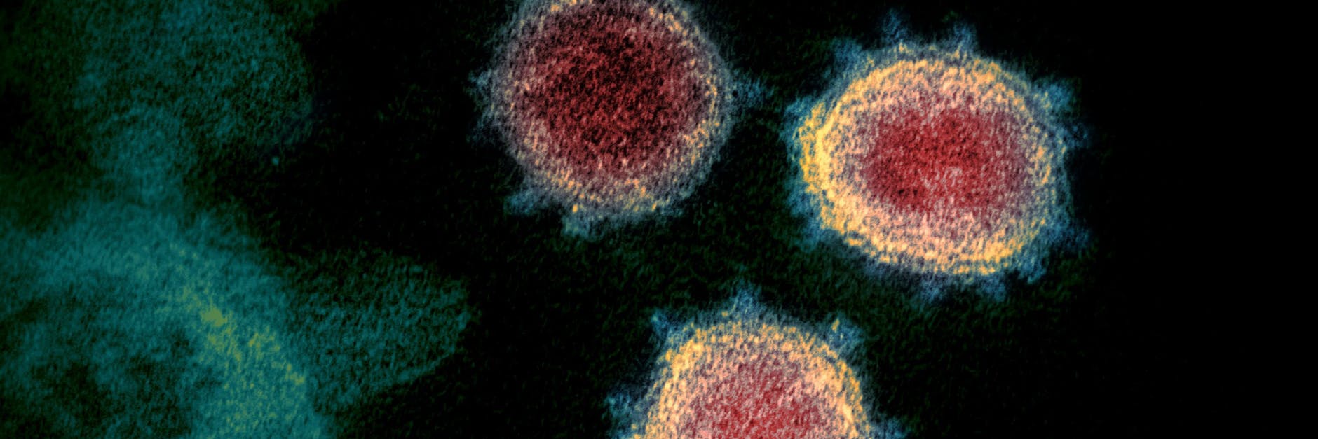 Das Sars-Cov-2-Virus unter einem Elektronen-Mikroskop.