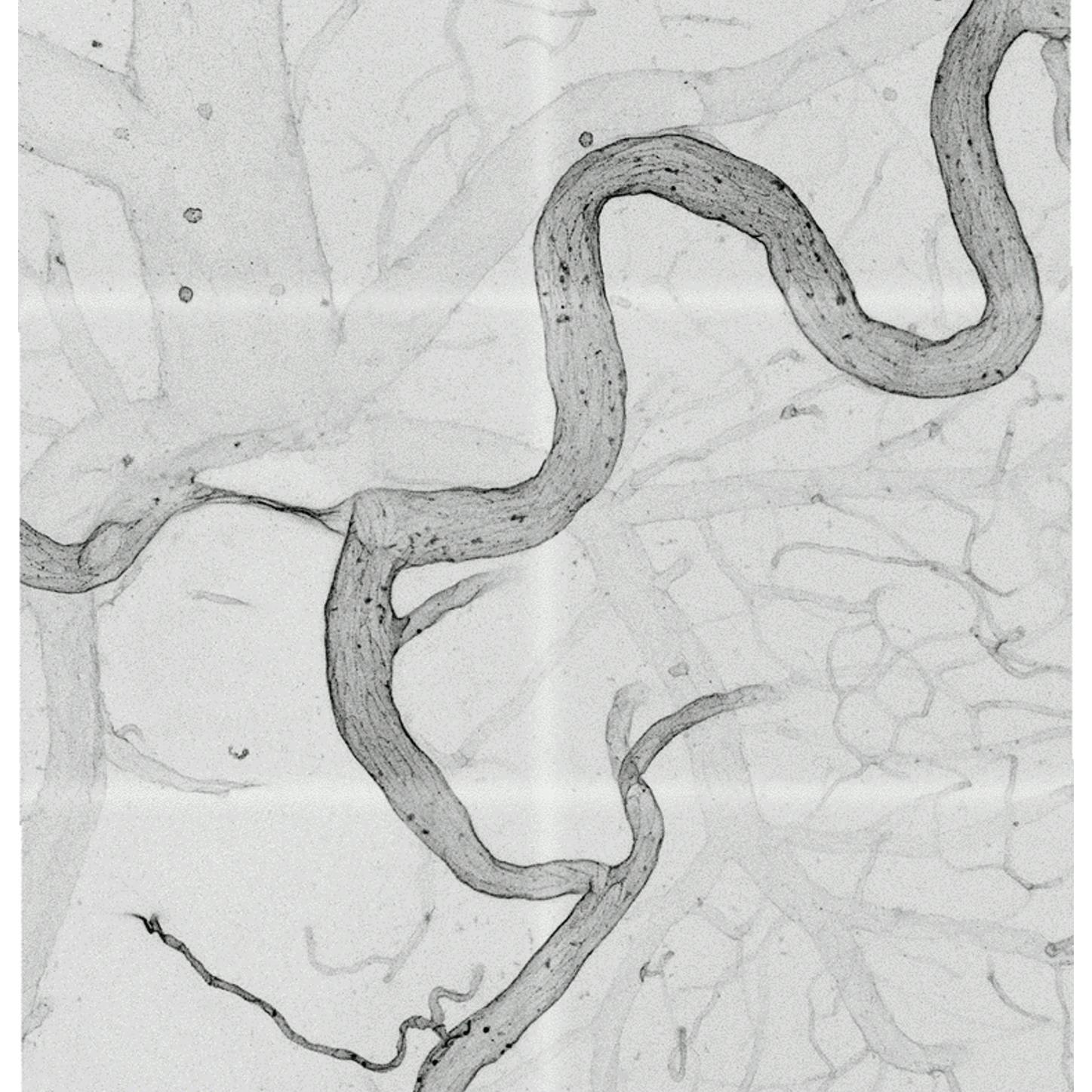 Bild eines Schlaganfalls im Gehirn. Das schlangenförmige Gefäß ist eine sogenannte Kollaterale, die nach dem Schlaganfall durch mehr Blutfluss größer und funktional wird.
