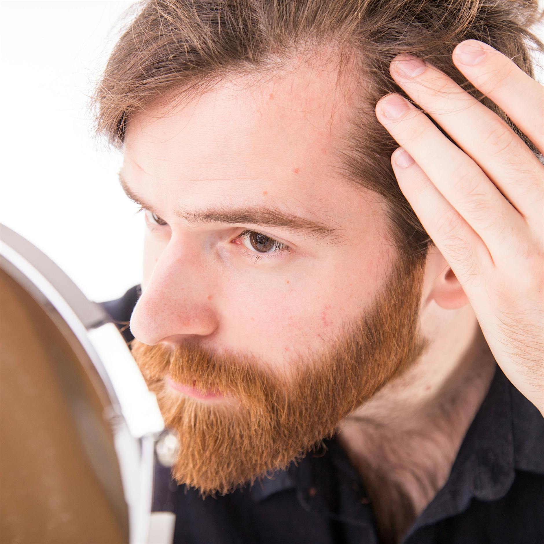 Erblicher Haarausfall: Was tun, wenn die Glatze kommt?