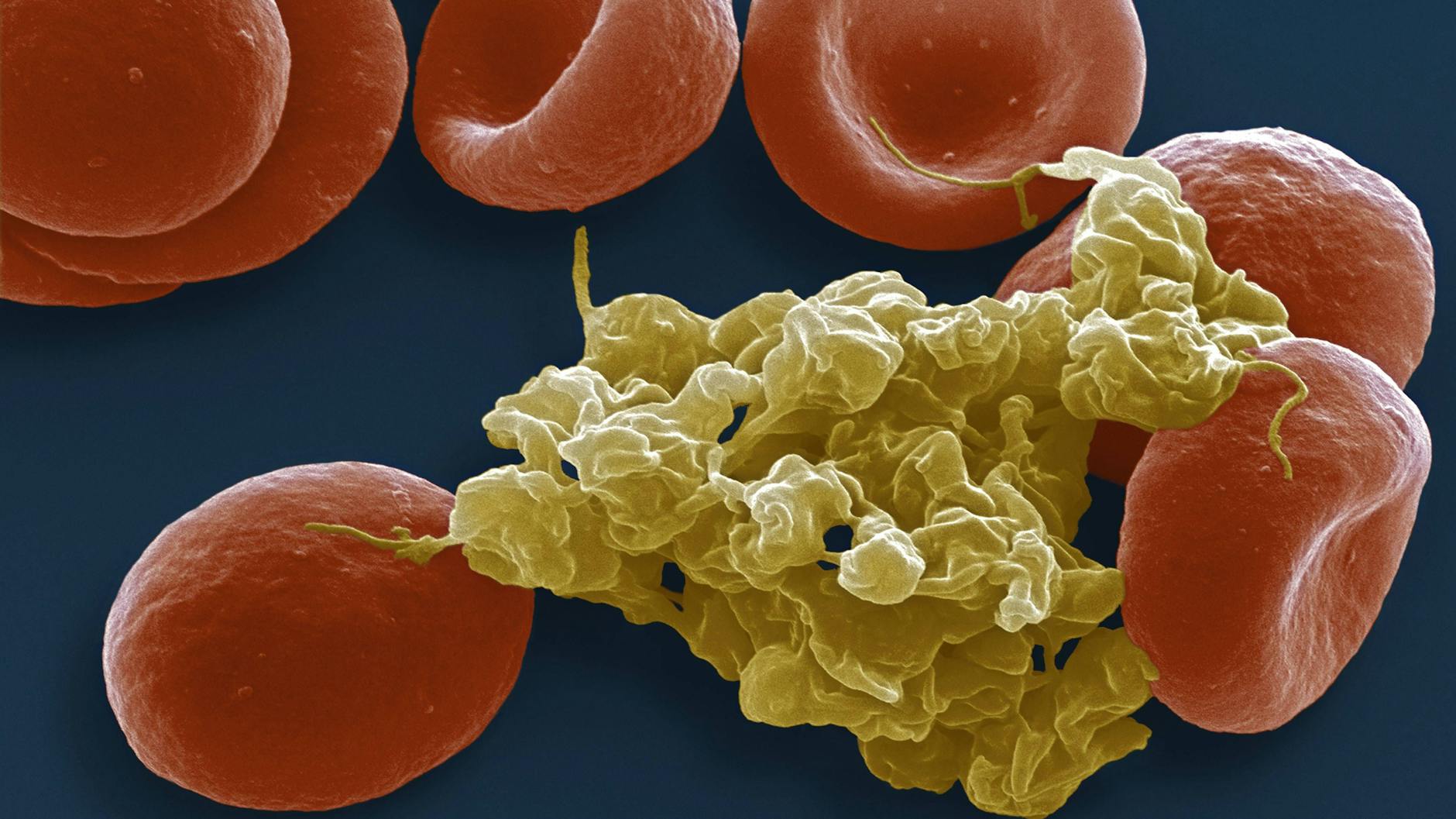 Die kolorierte Rasterelektronenmikroskop-Aufnahme zeigt rote Blutkörperchen und verklumpte Blutplättchen (gelb). 