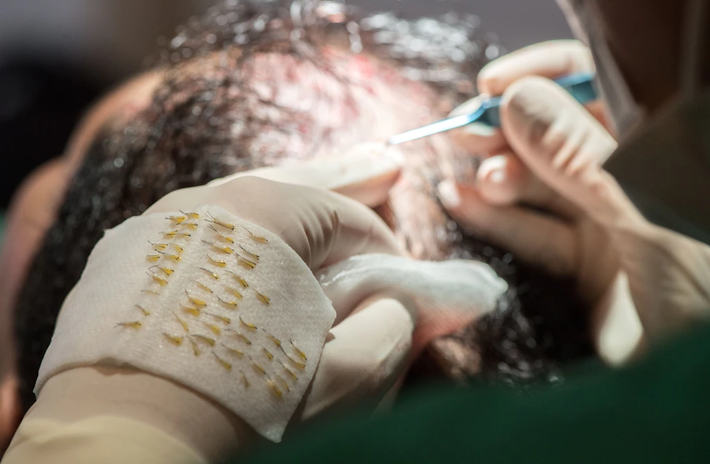 Misslungene Haartransplantation: Schönheitsklinik muss zahlen
