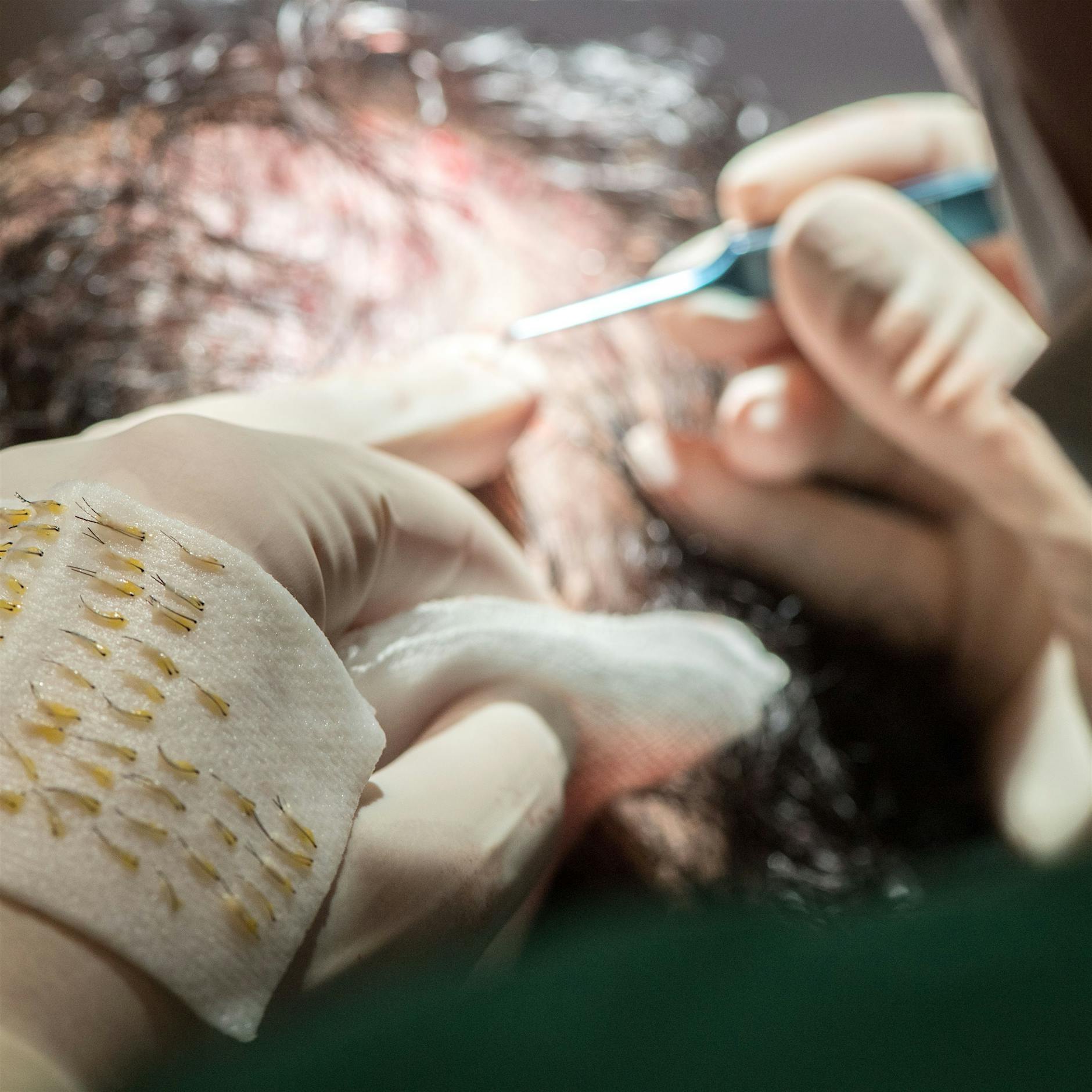 Misslungene Haartransplantation: Schönheitsklinik muss zahlen