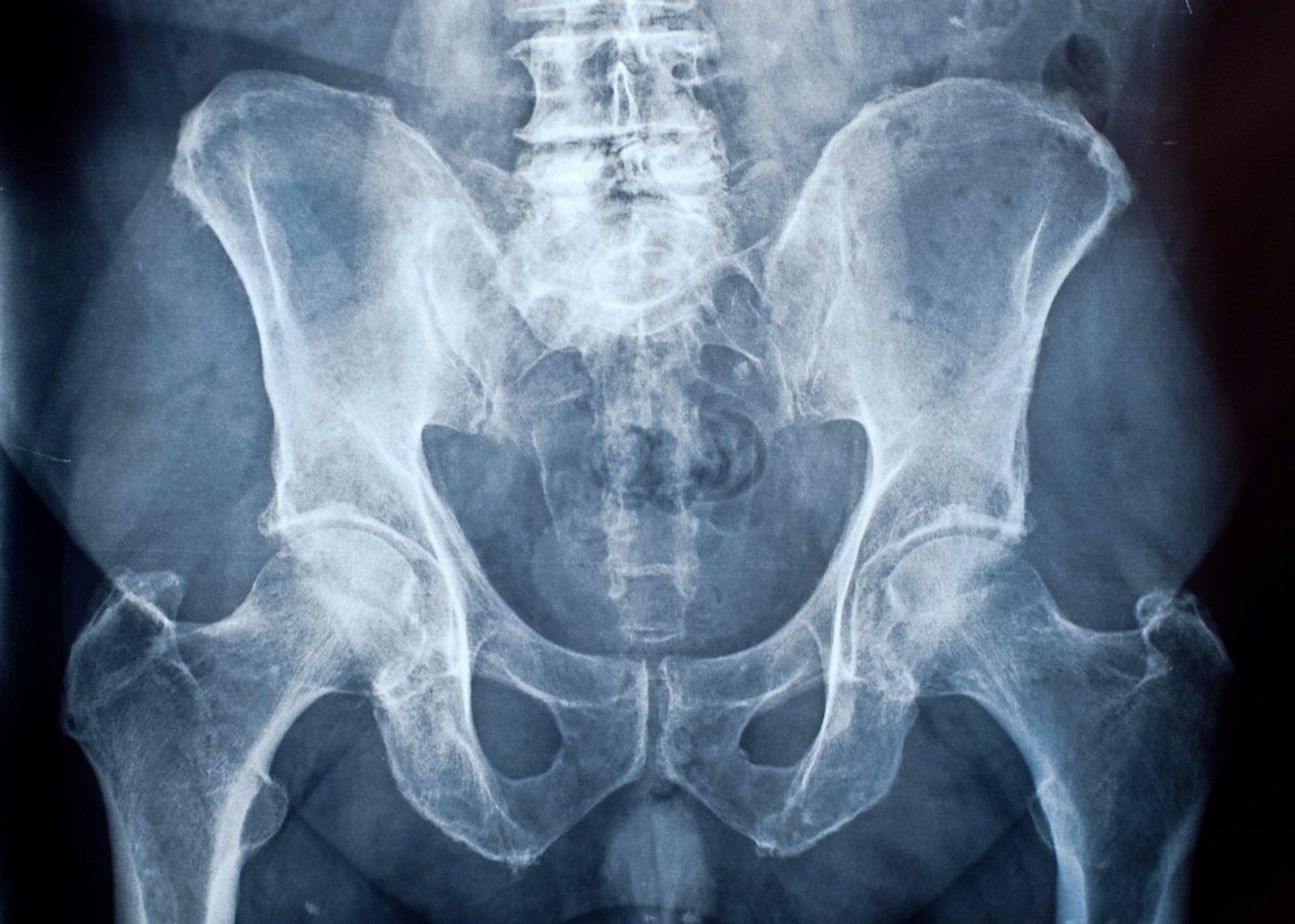 Sarkome: Menschen mit seltenen Krebsformen fühlen sich oft alleingelassen