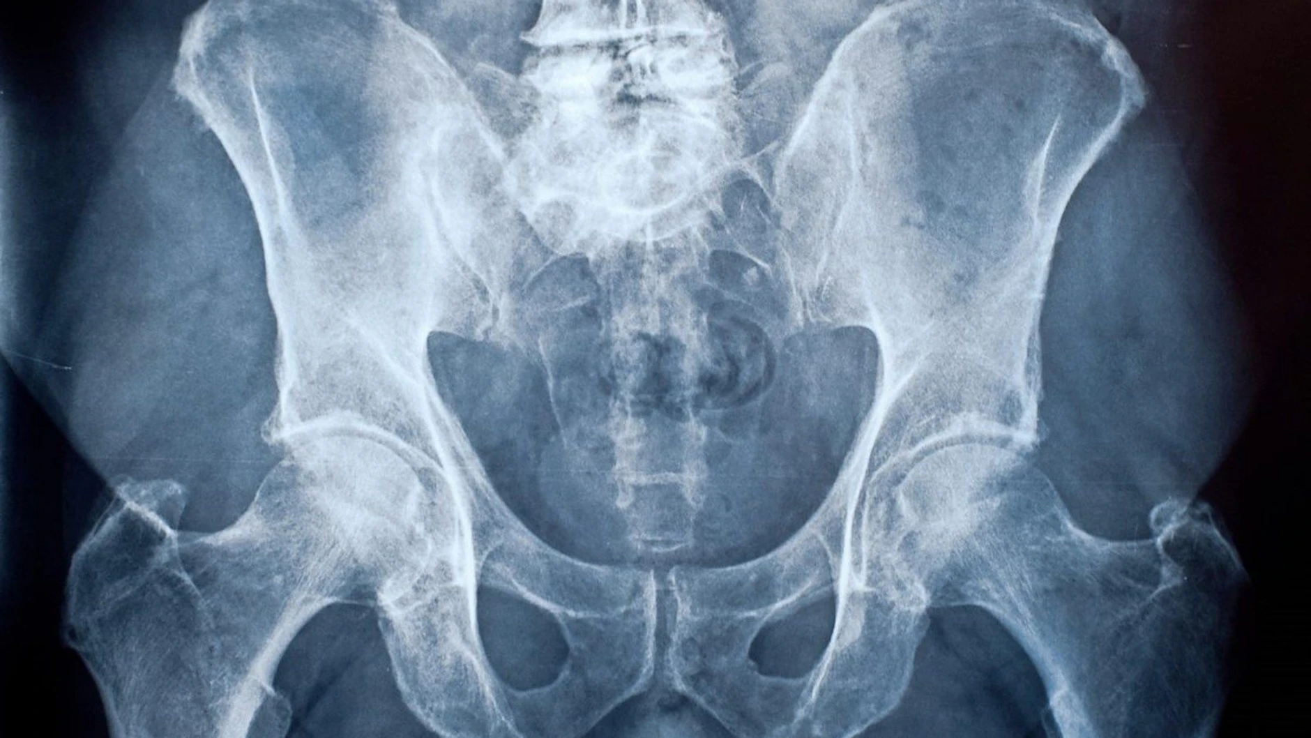 Weichteilsarkome entstehen auch im Beckenbereich. Schmerzen werden lange als Rückenleiden missinterpretiert.