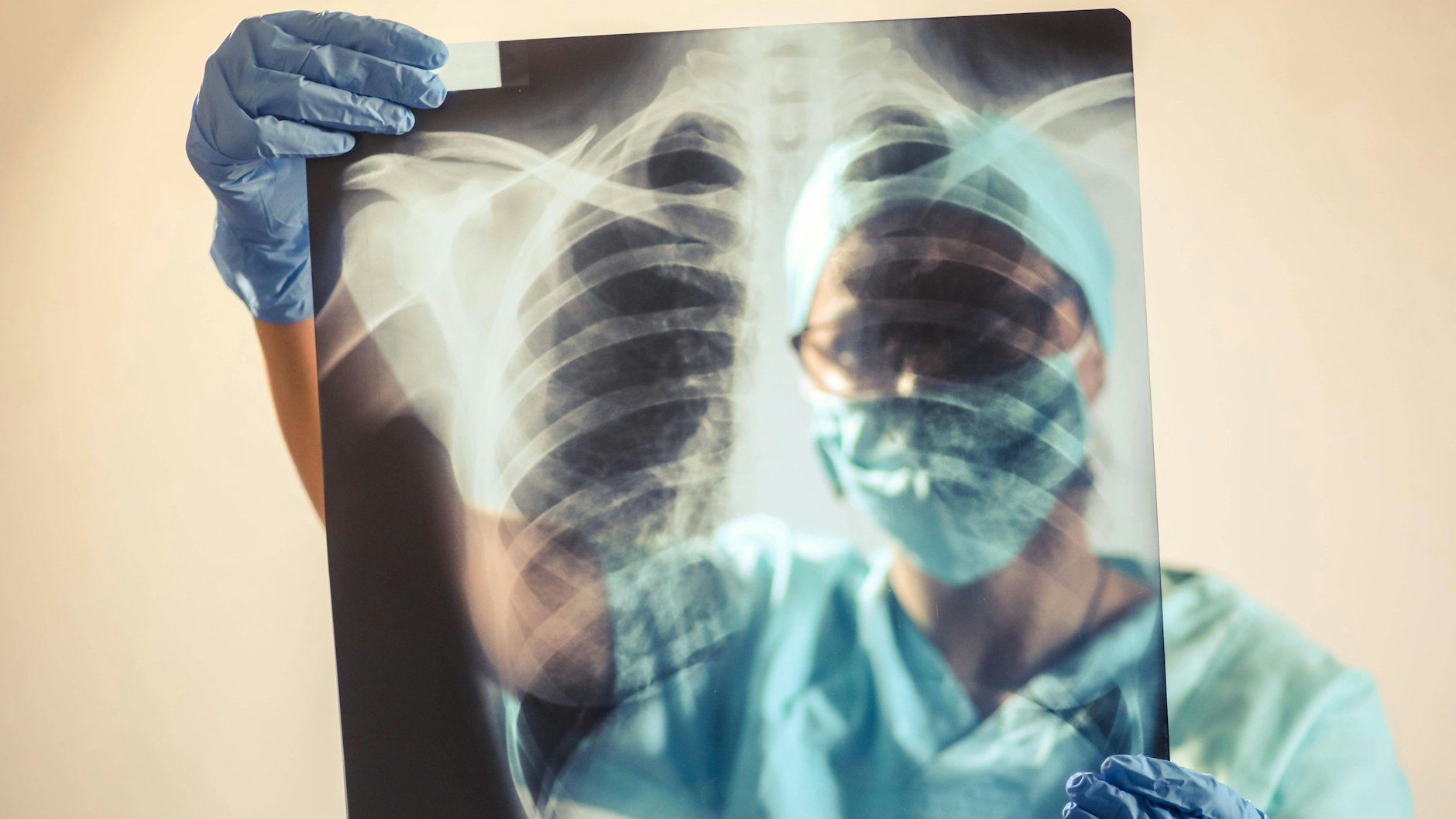 Vor allem in der Lunge fanden die Wissenschaftler viel Virus-RNA. Dort war das Gewebe auch schwer geschädigt.